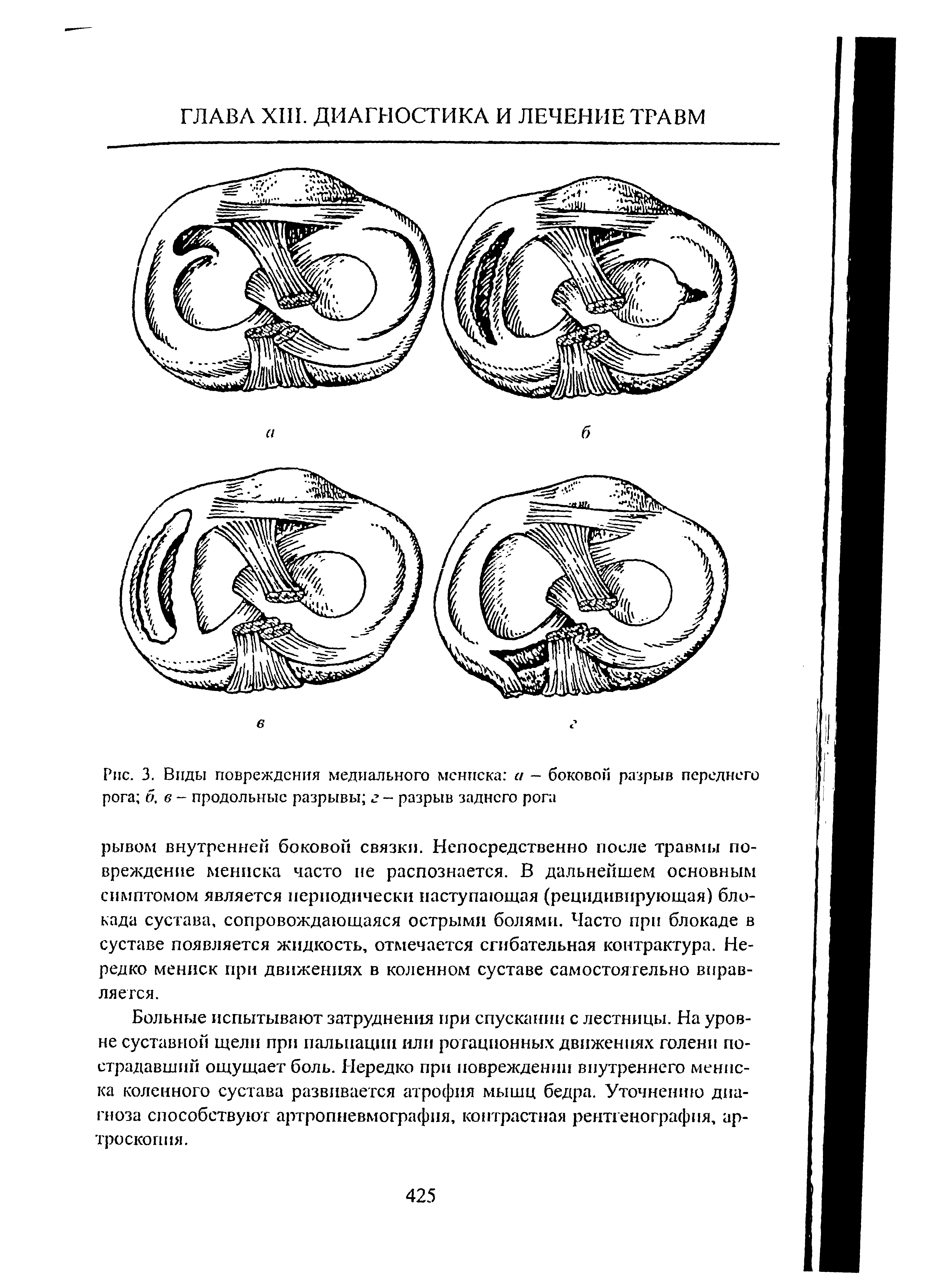 Рис. 3. Виды повреждения медиального мениска и - боковой разрыв переднего рога б, 6 - продольные разрывы г - разрыв заднего рога...