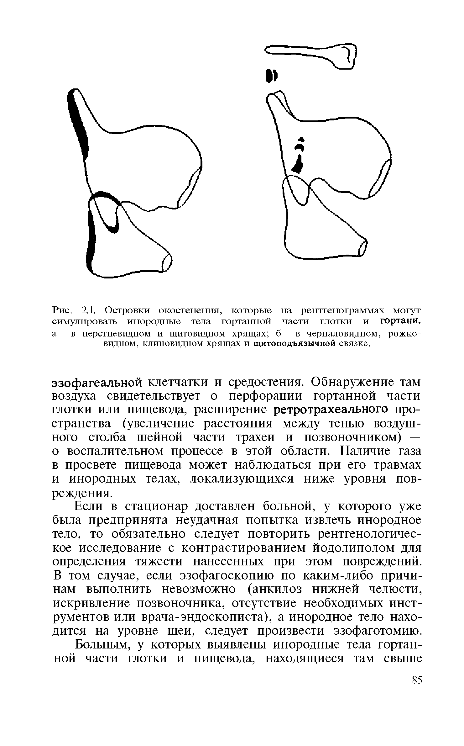 Рис. 2.1. Островки окостенения, которые на рентгенограммах могут симулировать инородные тела гортанной части глотки и гортани, а —в перстневидном и щитовидном хрящах б —в черпаловидном, рожковидном, клиновидном хрящах и щитоподъязычной связке.