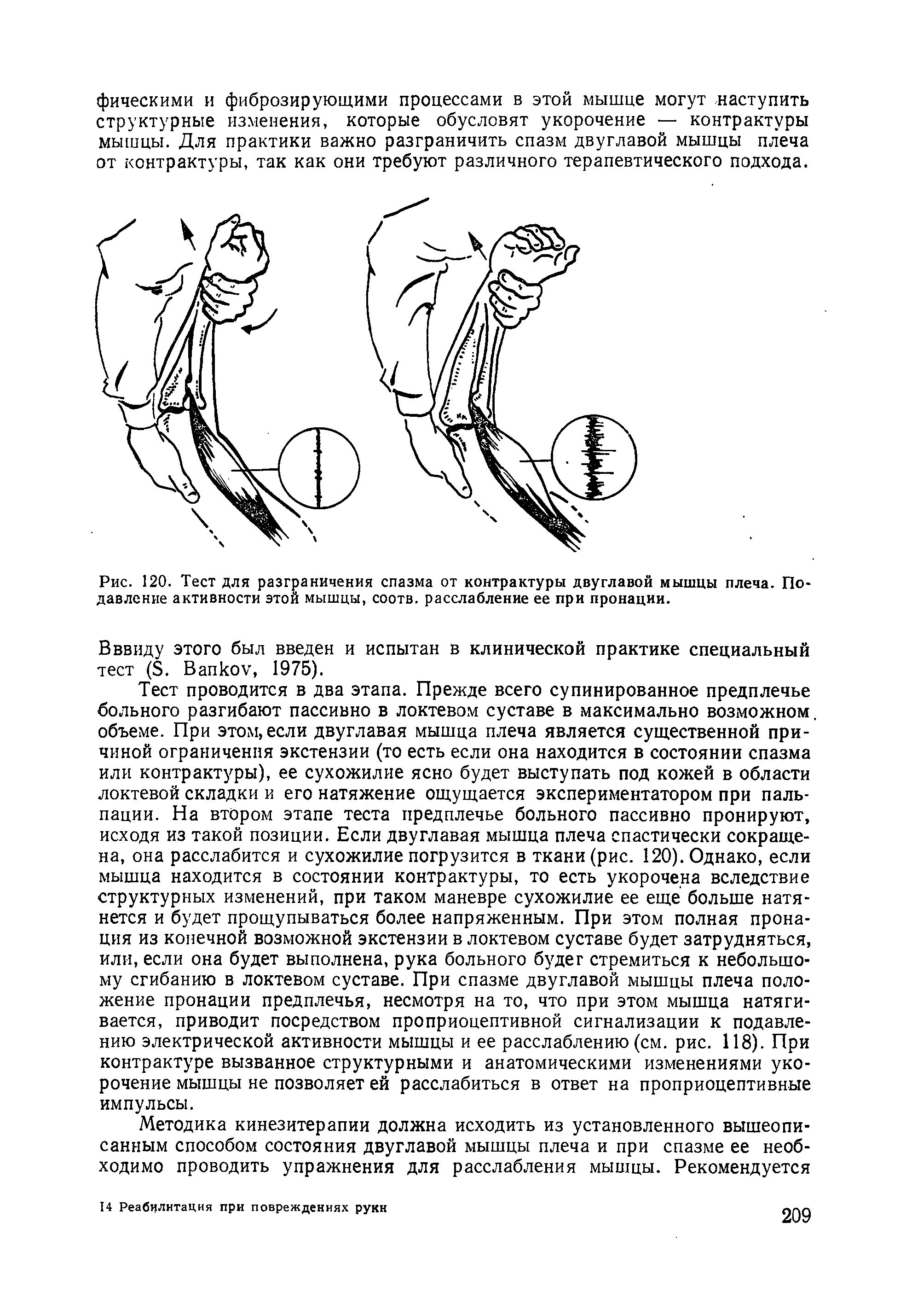Рис. 120. Тест для разграничения спазма от контрактуры двуглавой мышцы плеча. Подавление активности этой мышцы, соотв. расслабление ее при пронации.