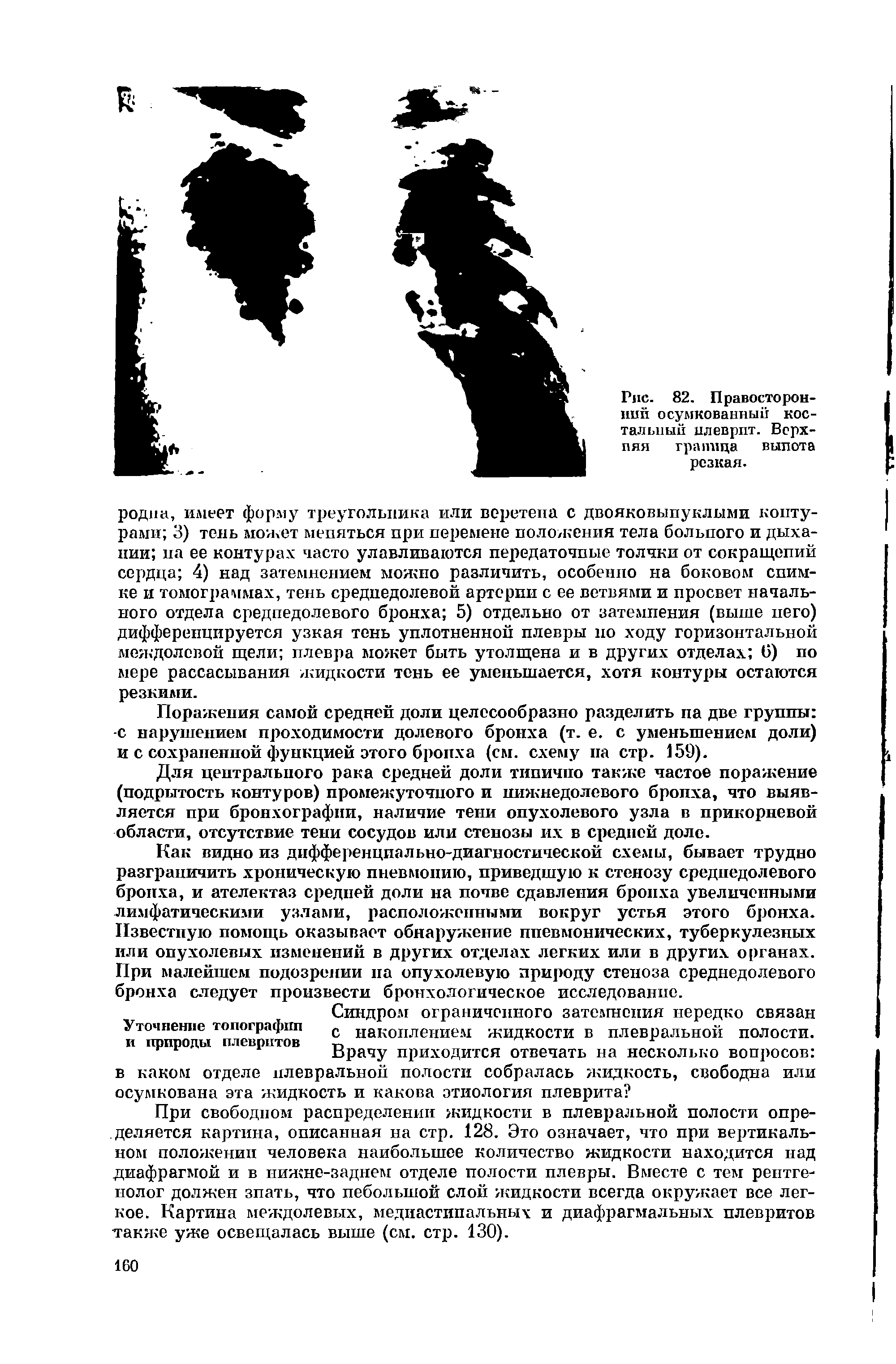 Рис. 82. Правосторонний осумкованный костальный плеврит. Верхняя граница выпота резкая.