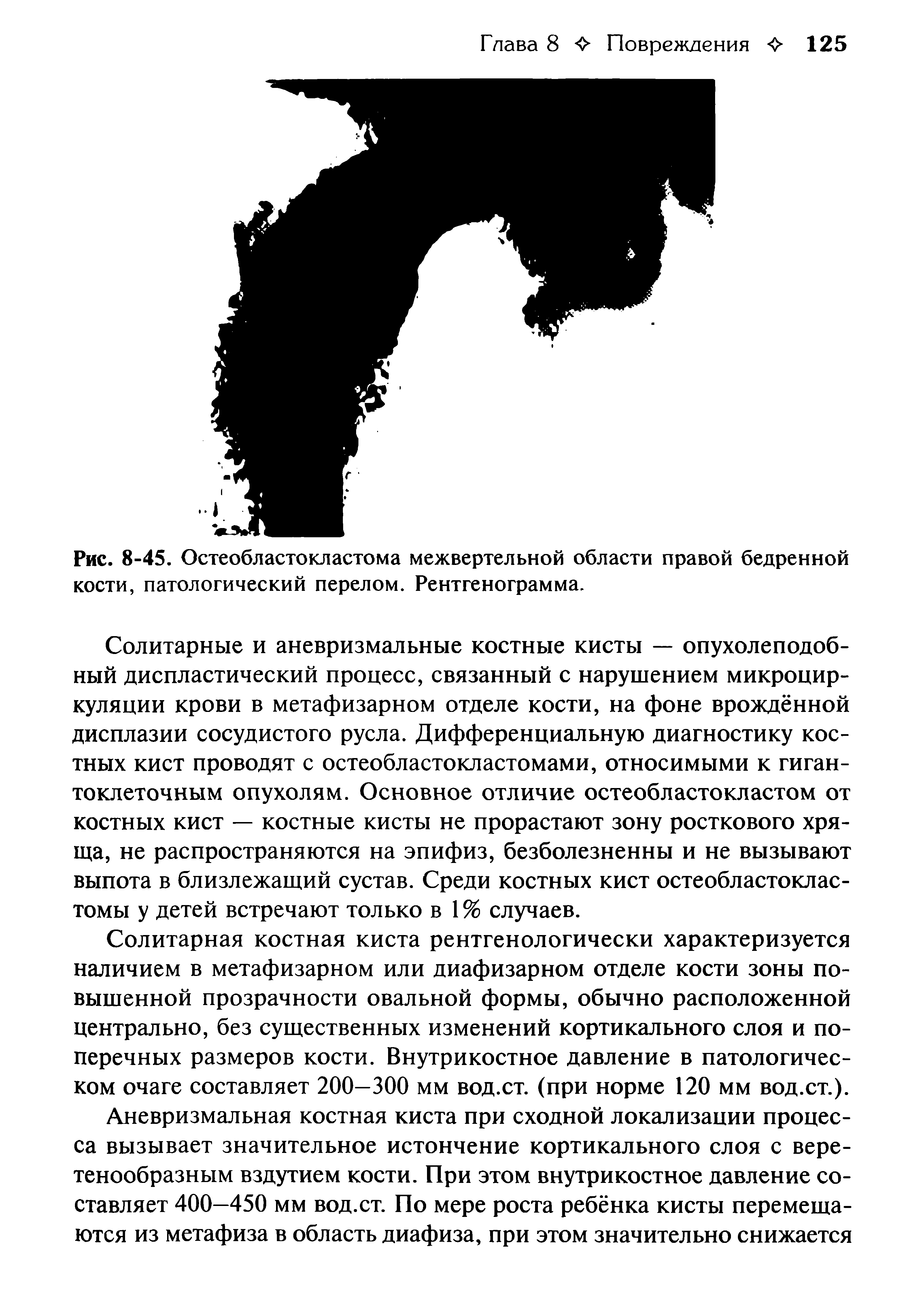 Рис. 8-45. Остеобластокластома межвертельной области правой бедренной кости, патологический перелом. Рентгенограмма.