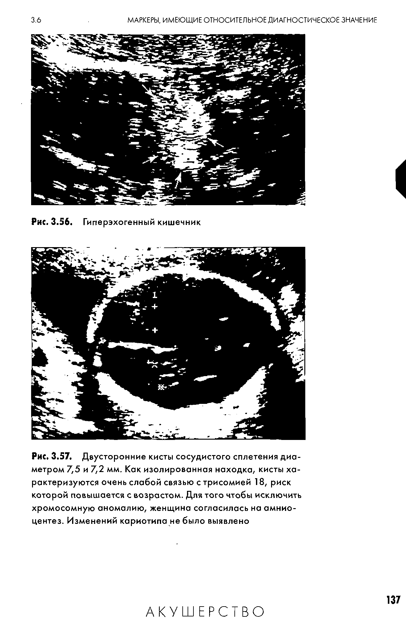 Рис. 3.57. Двусторонние кисты сосудистого сплетения диаметром 7,5 и 7,2 мм. Как изолированная находка, кисты характеризуются очень слабой связью с трисомией 18, риск которой повышается с возрастом. Для того чтобы исключить хромосомную аномалию, женщина согласилась на амниоцентез. Изменений кариотипа не было выявлено...