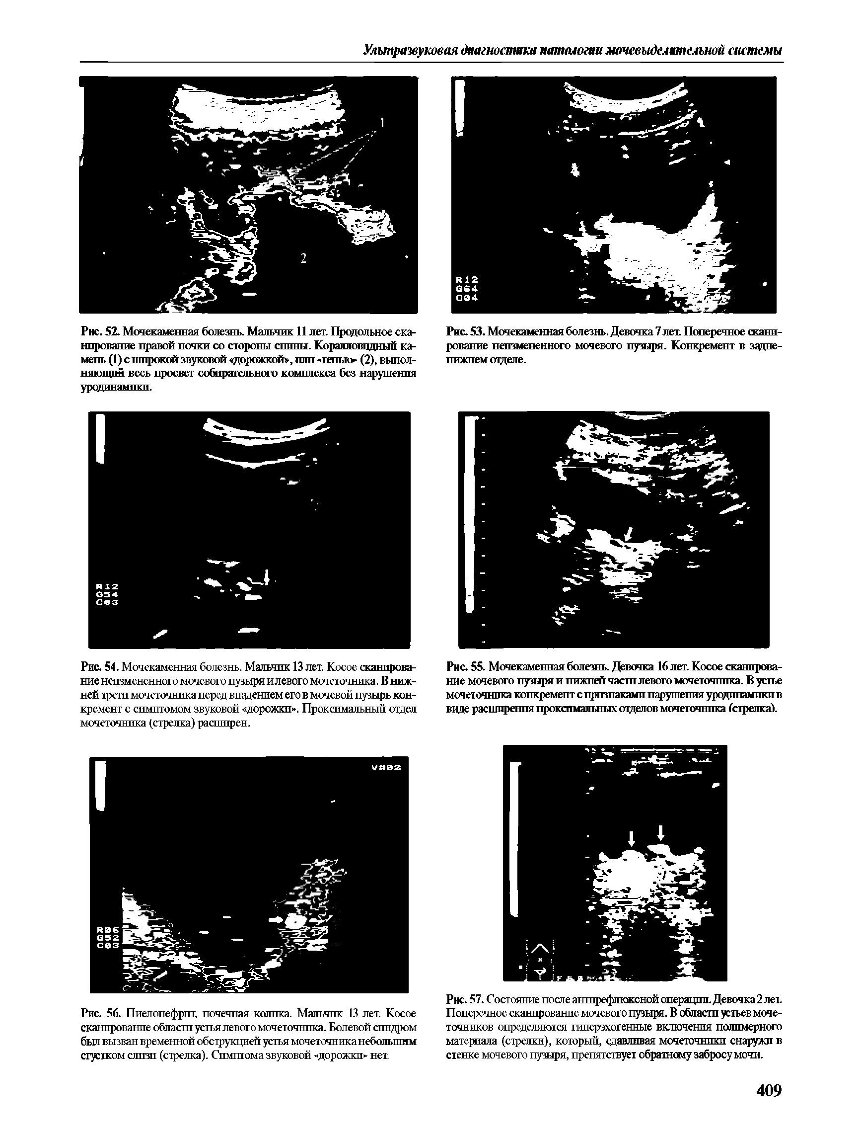 Рис. 54. Мочекаменная болезнь. Мальчик 13 лет. Косое сканирование неизмененного мочевого пузыря и левого мочеточника. В нижней трети мочеточника перед впадением его в мочевой пузырь конкремент с симптомом звуковой дорожки . Проксимальный отдел мочеточника (стрелка) расширен.