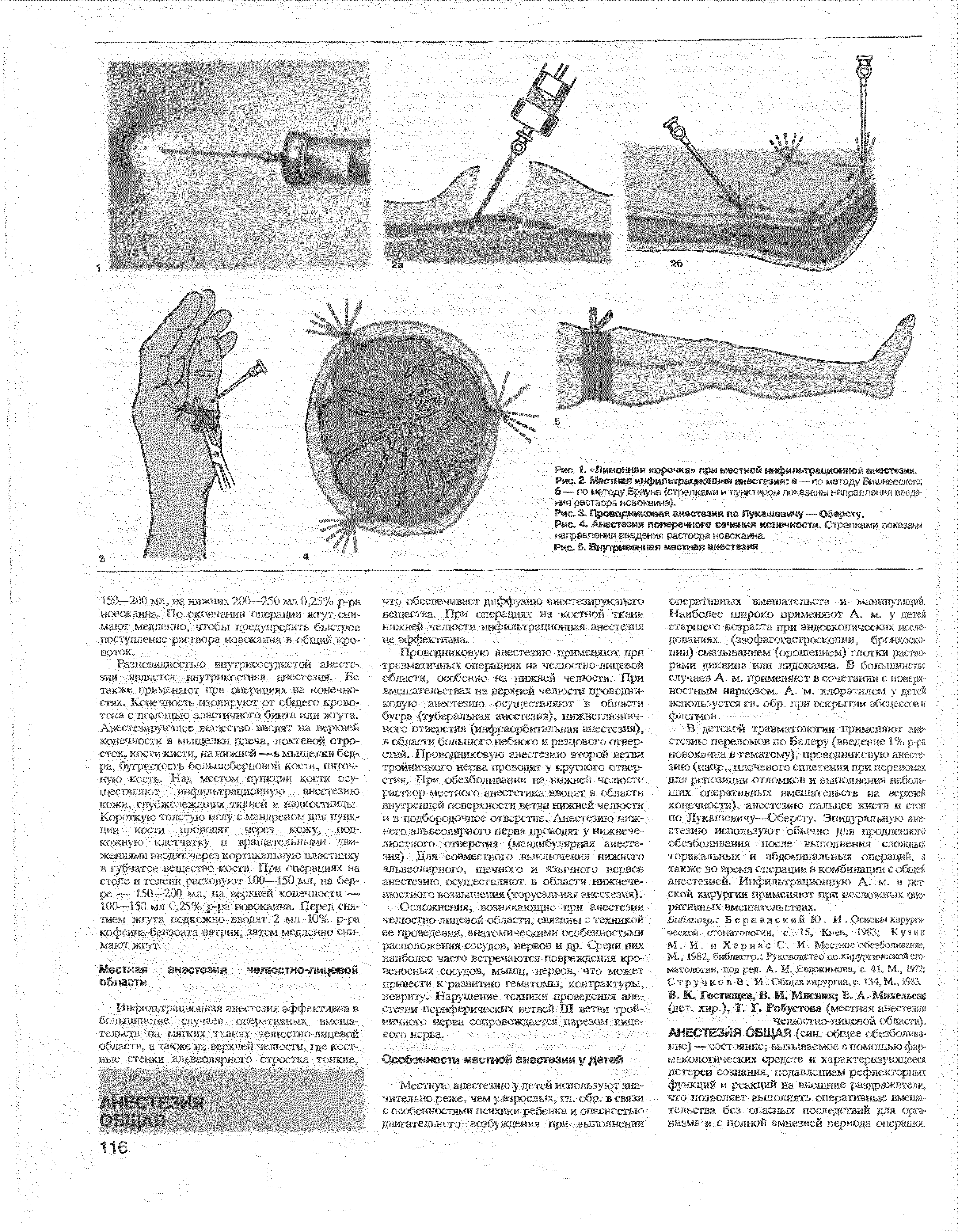 Рис. 4. Анестезия поперечного сечения конечности. Стрелками показаны направления введения растеорд новокаина. . ...