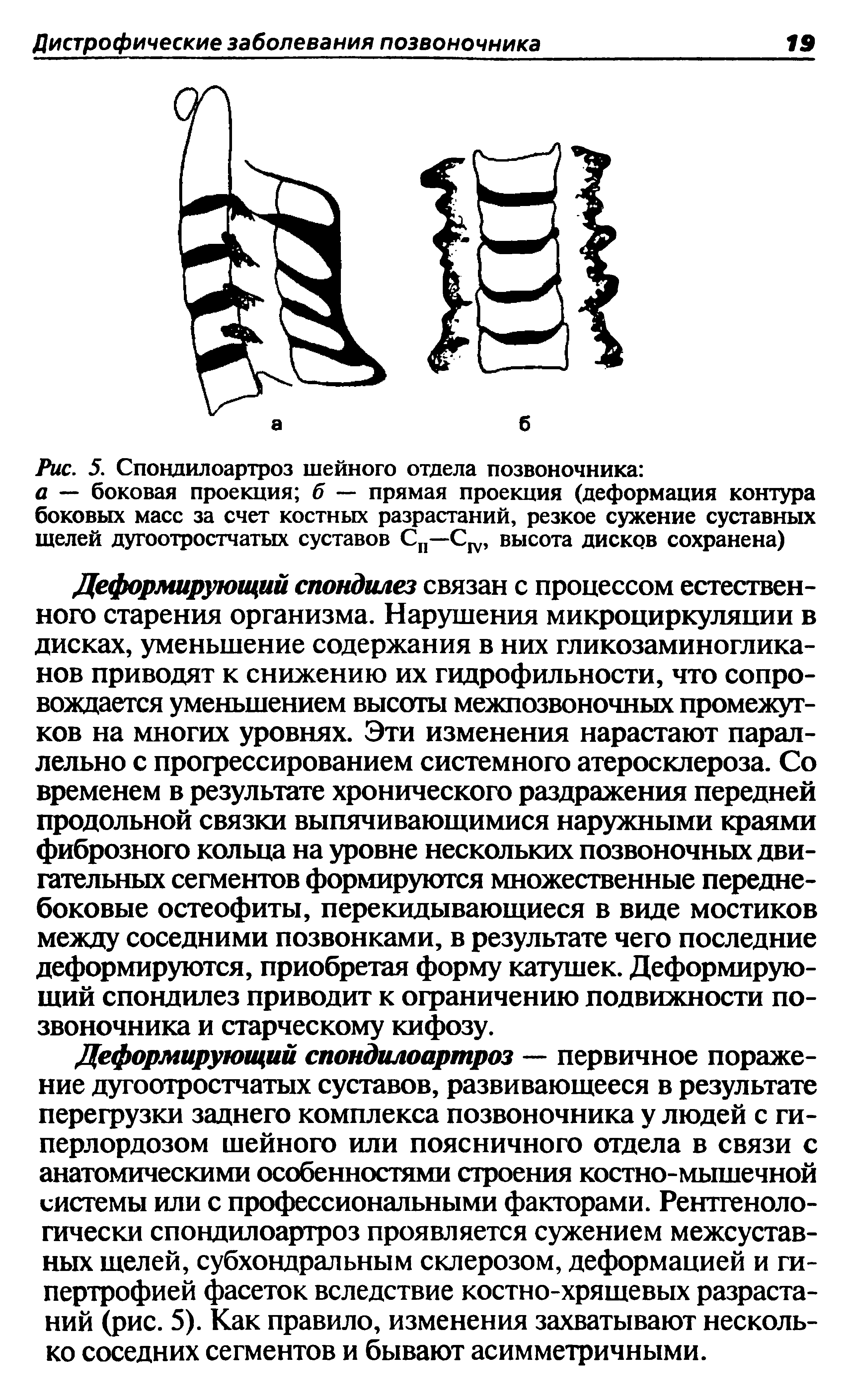 Рис. 5. Спондилоартроз шейного отдела позвоночника а — боковая проекция б — прямая проекция (деформация контура боковых масс за счет костных разрастаний, резкое сужение суставных щелей дугоотростчатых суставов Сп—С, высота дисков сохранена)...