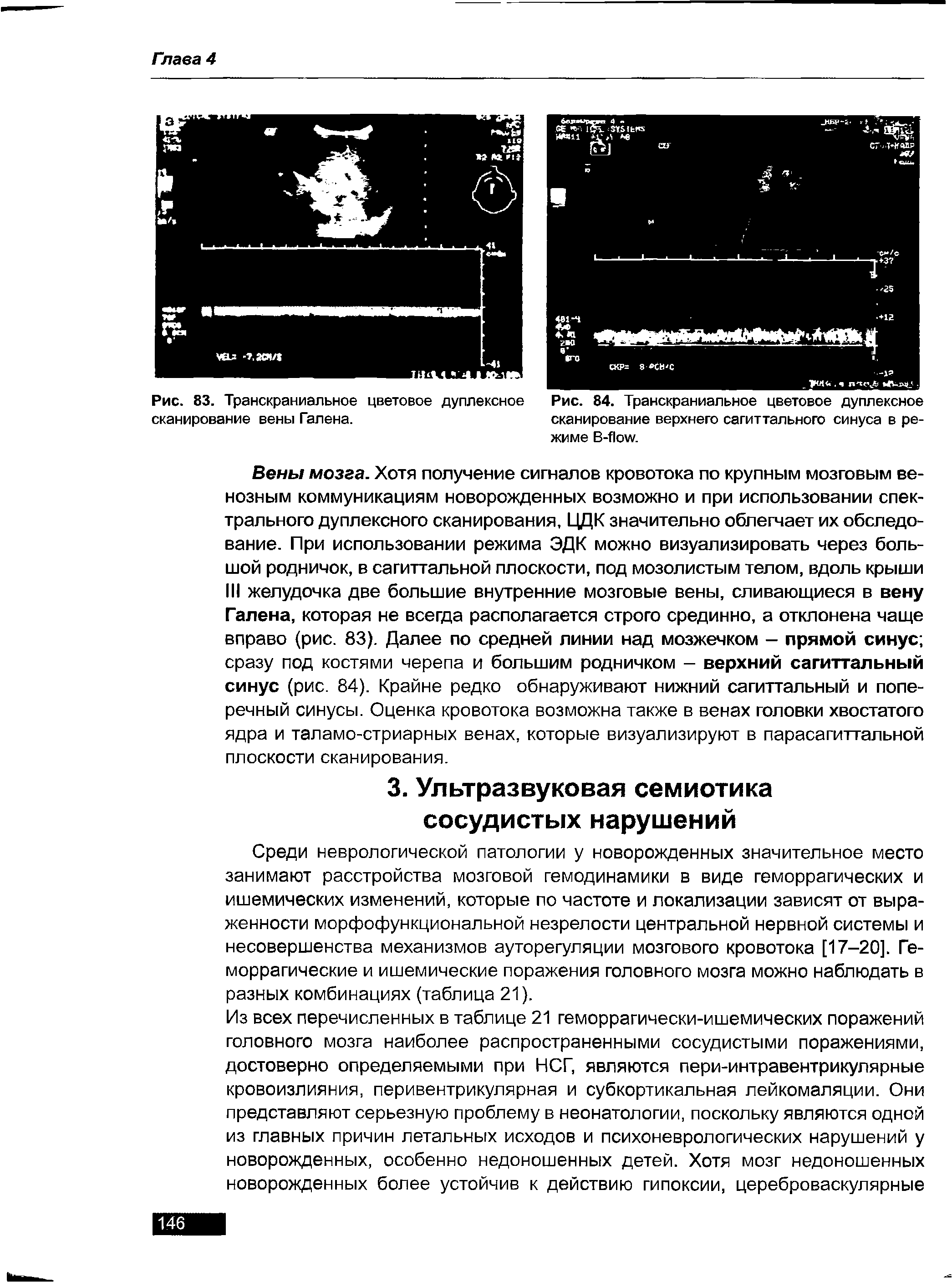 Рис. 83. Транскраниальное цветовое дуплексное сканирование вены Галена.