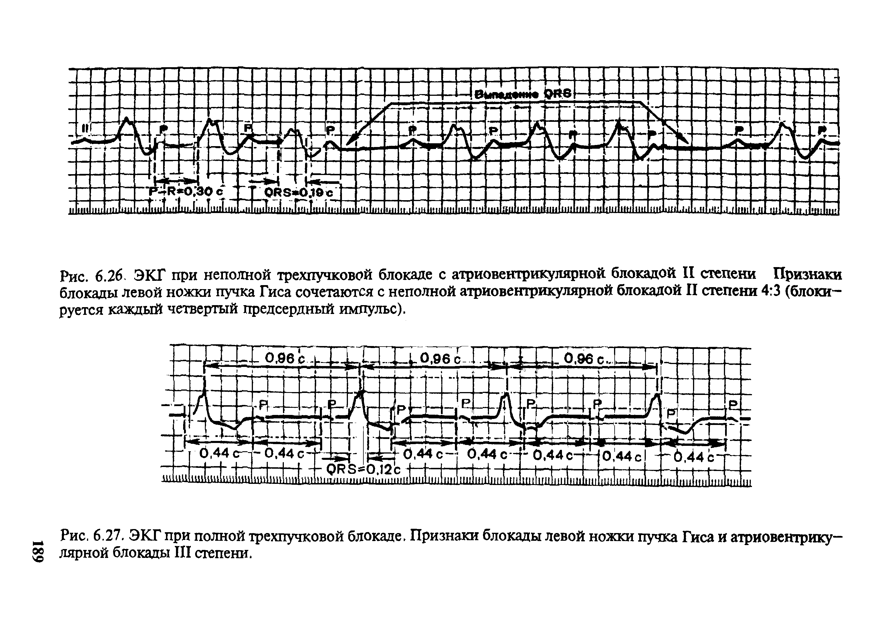 Рис. 6.27. ЭКГ при полной трехпучковой блокаде. Признаки блокады левой ножки пучка Гиса и атриовентрику- лярной блокады III степени.