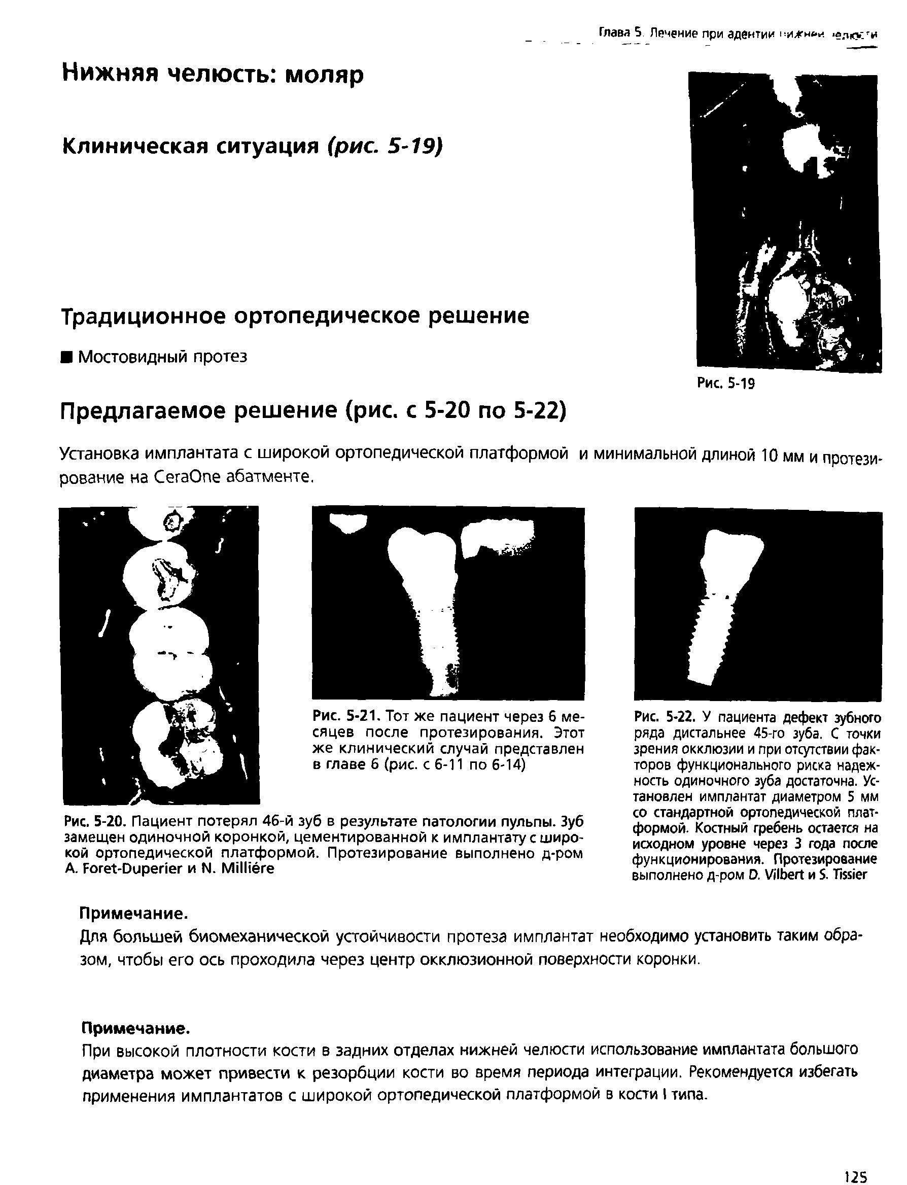 Рис. 5-20. Пациент потерял 46-й зуб в результате патологии пульпы. Зуб замещен одиночной коронкой, цементированной к имплантату с широкой ортопедической платформой. Протезирование выполнено д-ром А. Рогег-Оирепег и N. МИНёге...