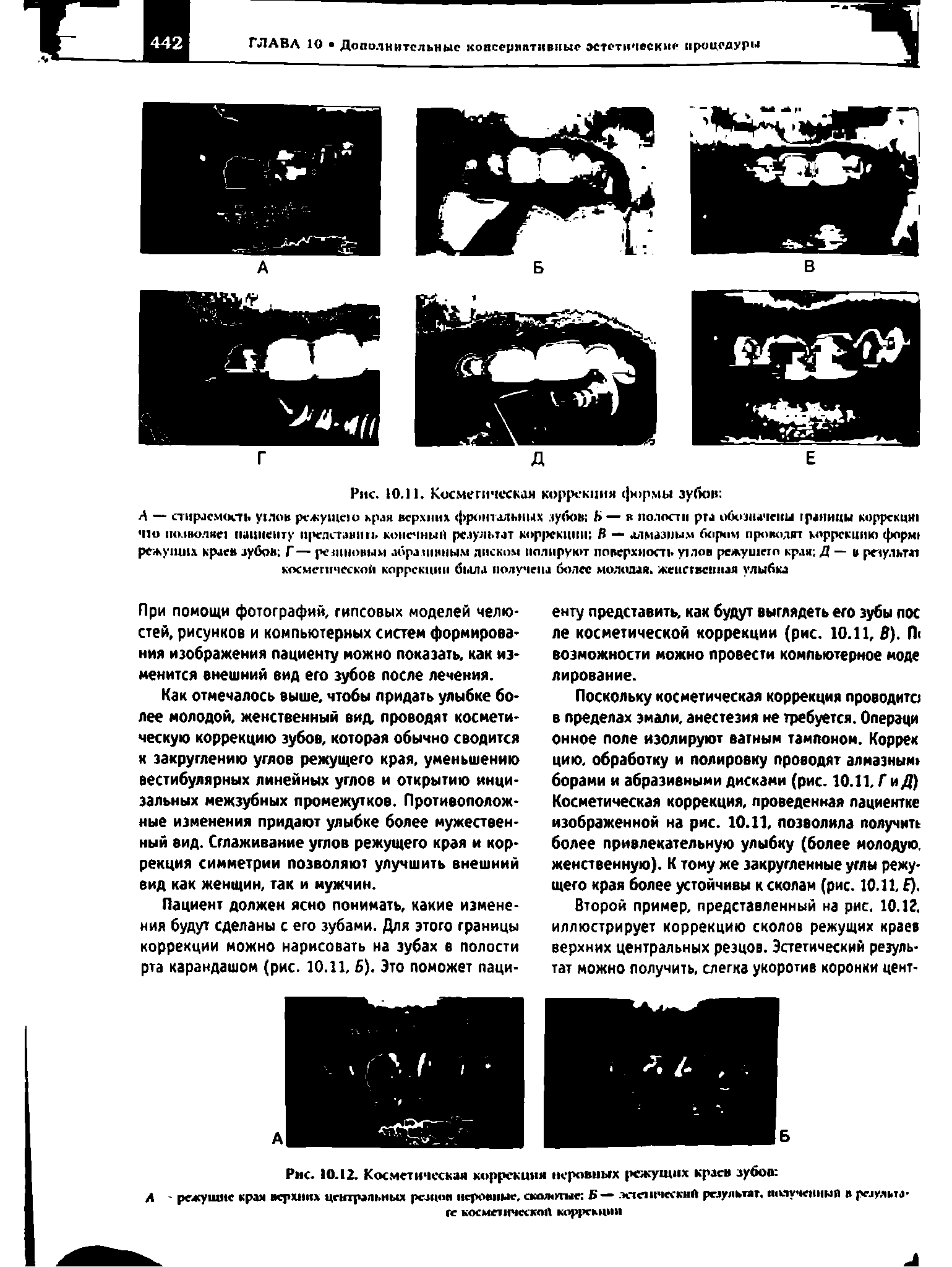 Рис. 10.12. Косметическая коррекция неровных режущих краев зубов ...