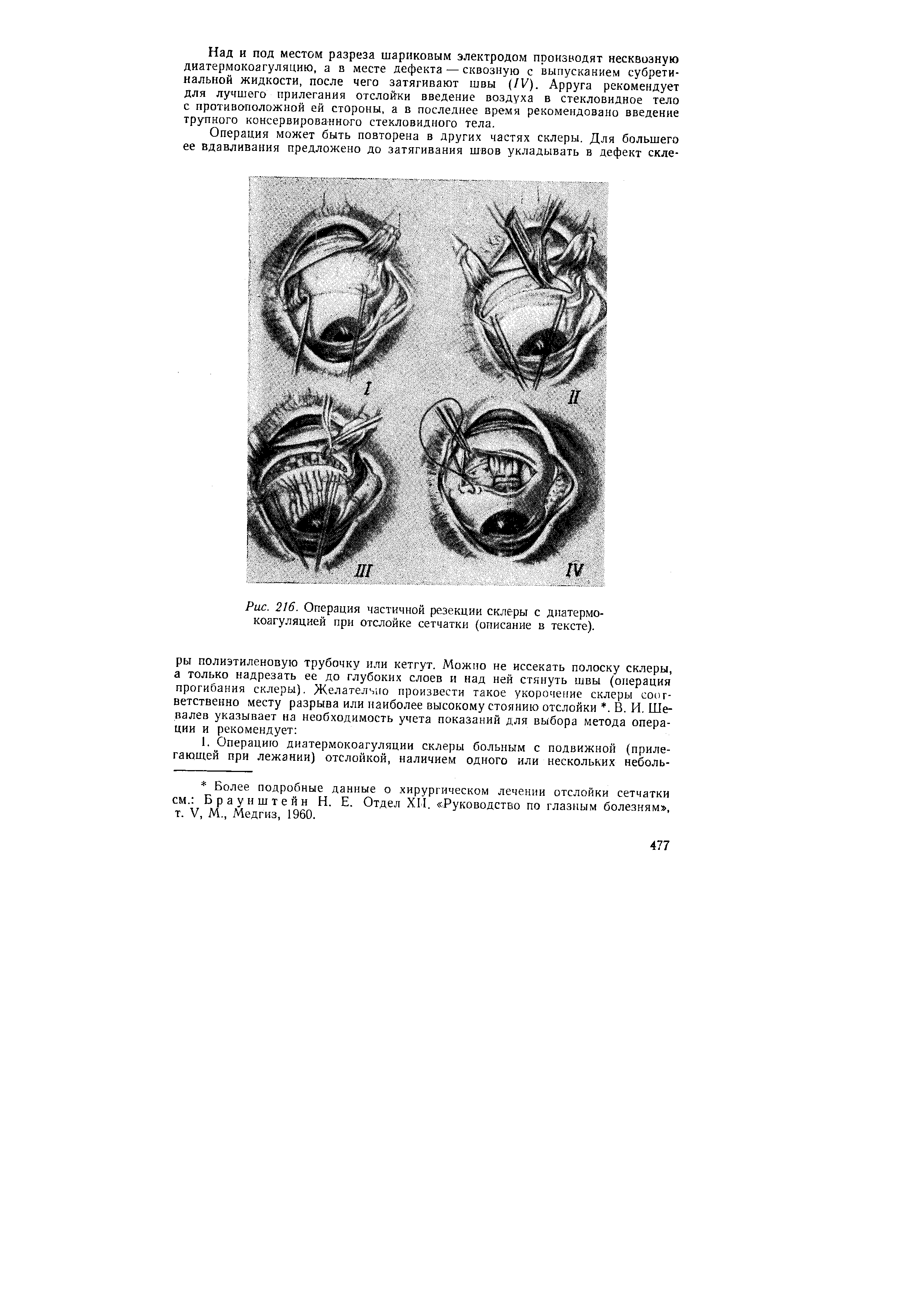 Рис. 216. Операция частичной резекции склеры с диатермокоагуляцией при отслойке сетчатки (описание в тексте).