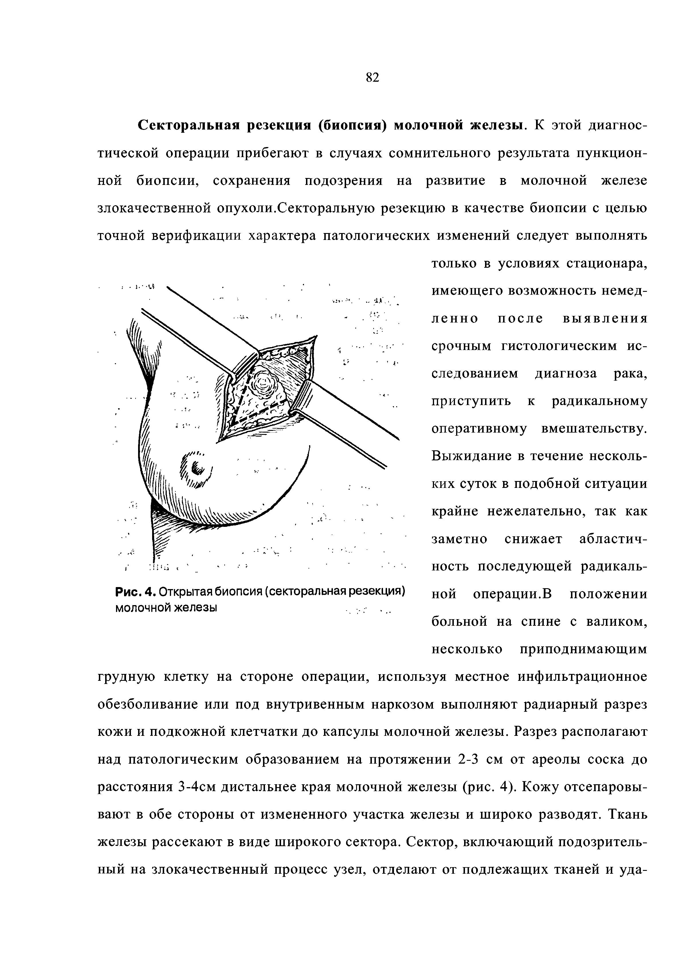 Рис. 4. Открытая биопсия (секторальная резекция) молочной железы...