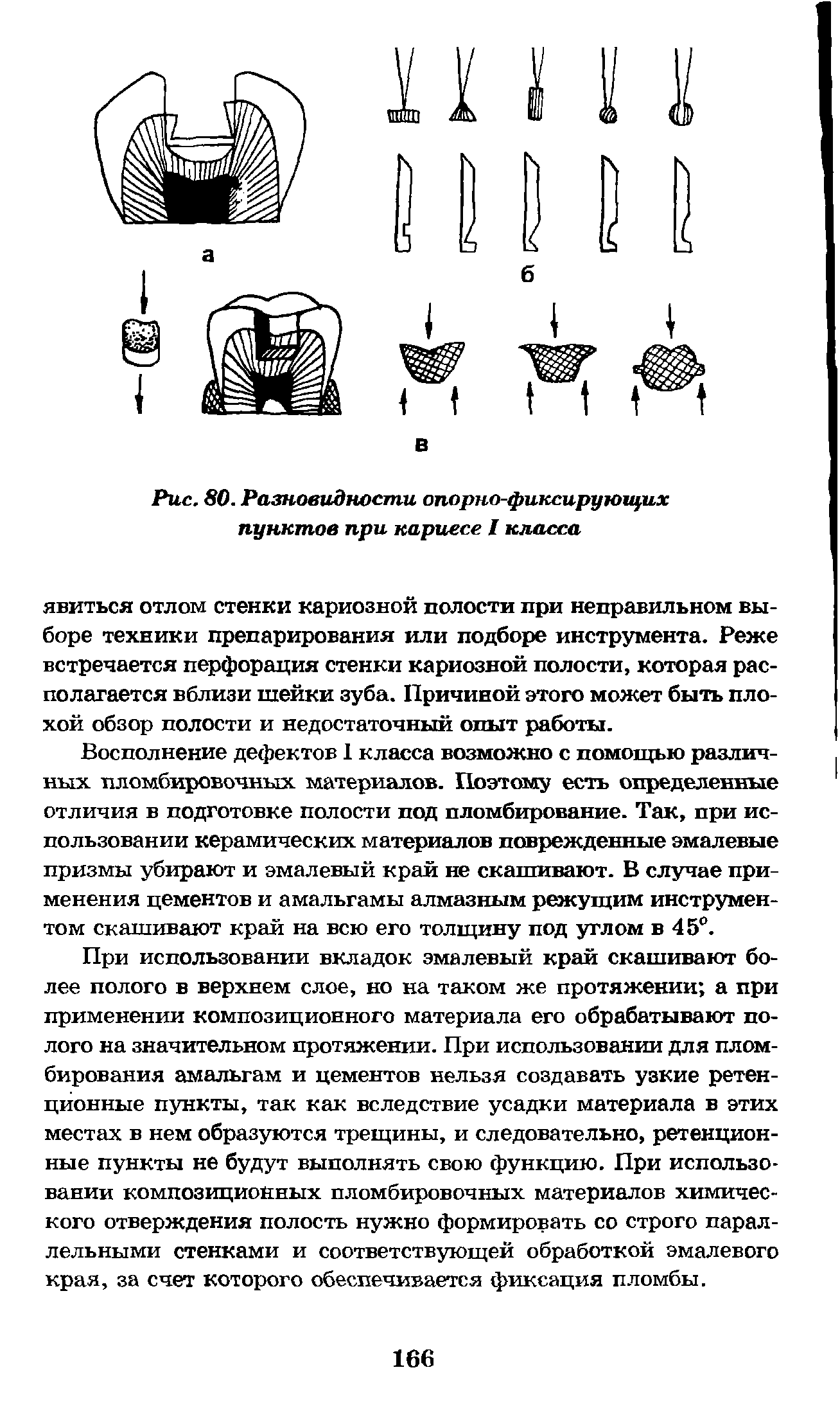 Рис. 80. Разновидности опорно-фиксирующих пунктов при кариесе I класса...