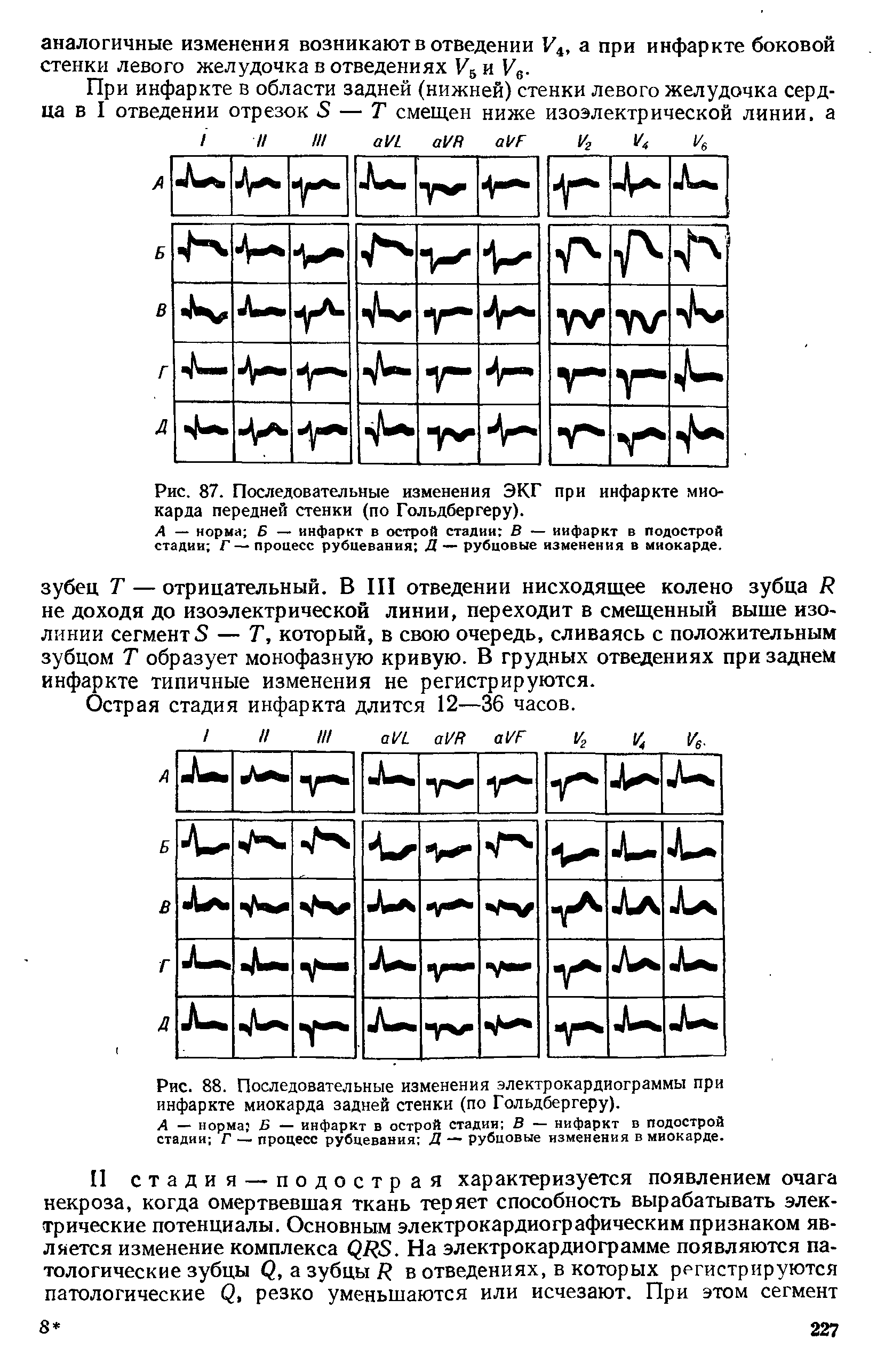 Рис. 87. Последовательные изменения ЭКГ при инфаркте миокарда передней стенки (по Гольдбергеру).