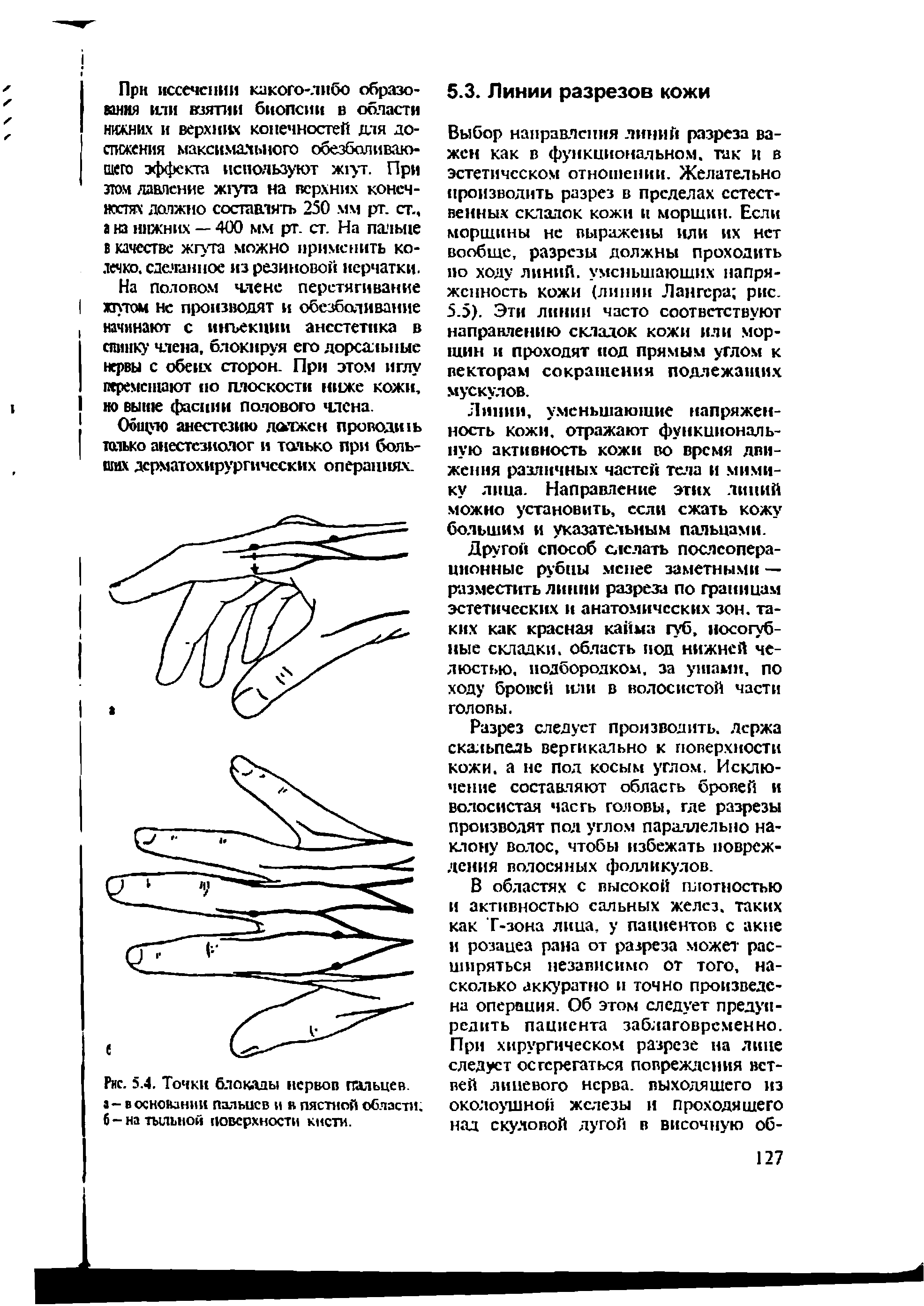 Рис. 5.4. Точки блокады нервов пальцев, а - в основании пальцев и в пястной области, б-на тыльной поверхности кисти.