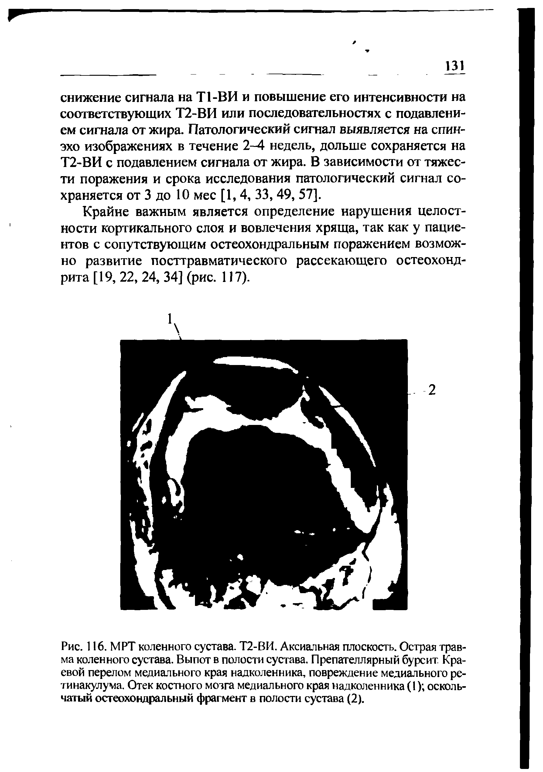 Рис. 116. МРТ коленного сустава. Т2-ВИ. Аксиальная плоскость. Острая травма коленного сустава. Выпот в полости сустава. Препателлярный бурсит. Краевой перелом медиального края надколенника, повреждение медиального ре-тинакулума. Отек костного мозга медиального края надколенника (1) оскольчатый остеохондральный фрагмент в полости сустава (2).