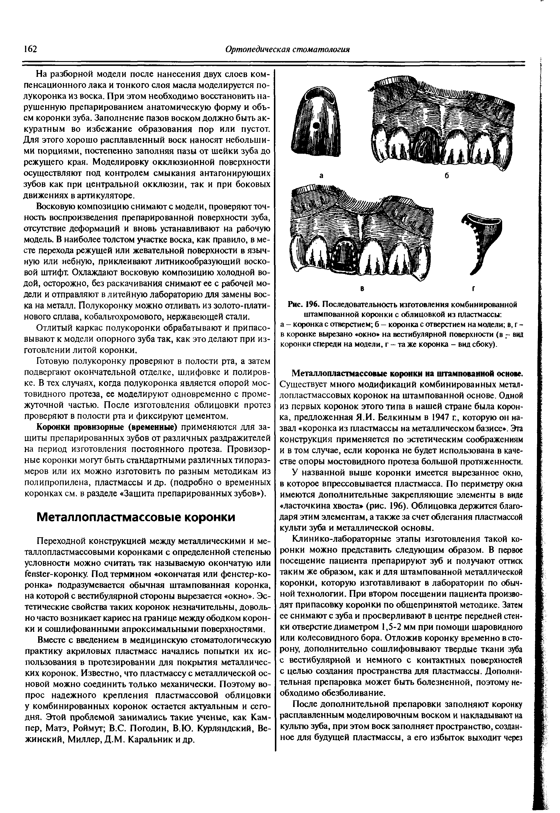 Рис. 196. Последовательность изготовления комбинированной штампованной коронки с облицовкой из пластмассы а - коронка с отверстием б — коронка с отверстием на модели в, г -в коронке вырезано окно на вестибулярной поверхности (в - вид коронки спереди на модели, г - та же коронка - вид сбоку).