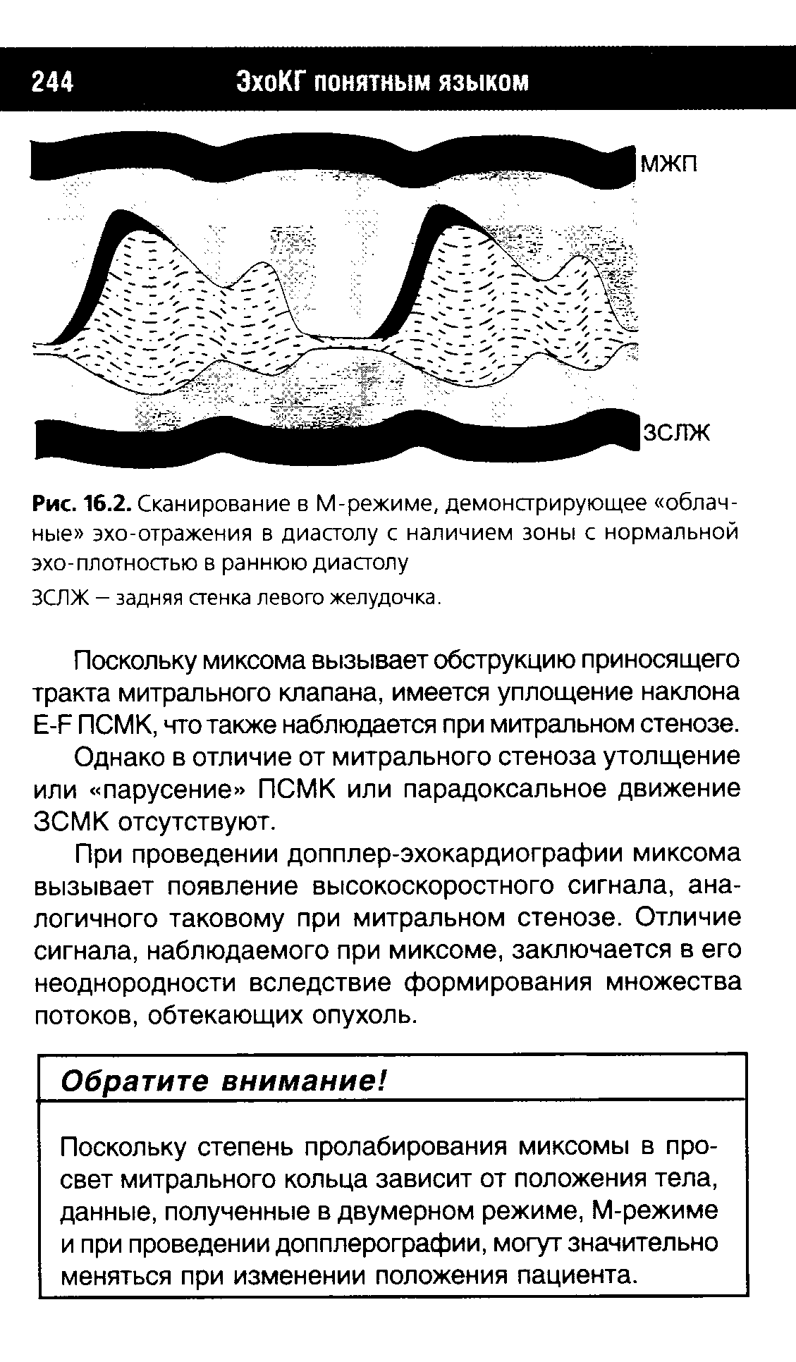 Рис. 16.2. Сканирование в М-режиме, демонстрирующее облачные эхо-отражения в диастолу с наличием зоны с нормальной эхо-плотностью в раннюю диастолу...