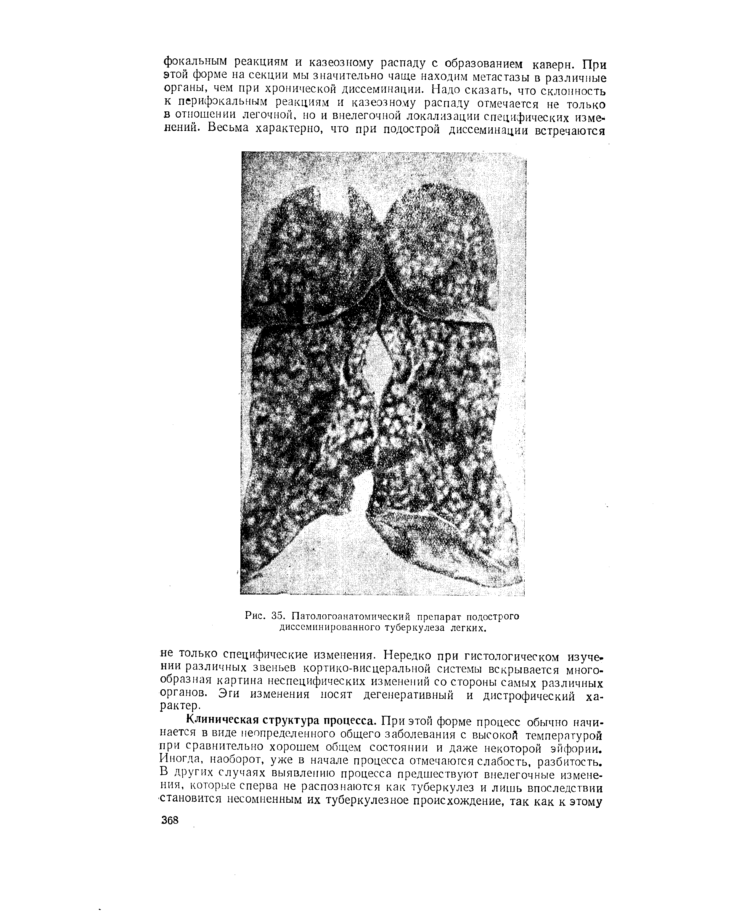 Рис. 35. Патологоанатомический препарат подострого диссеминированного туберкулеза легких.