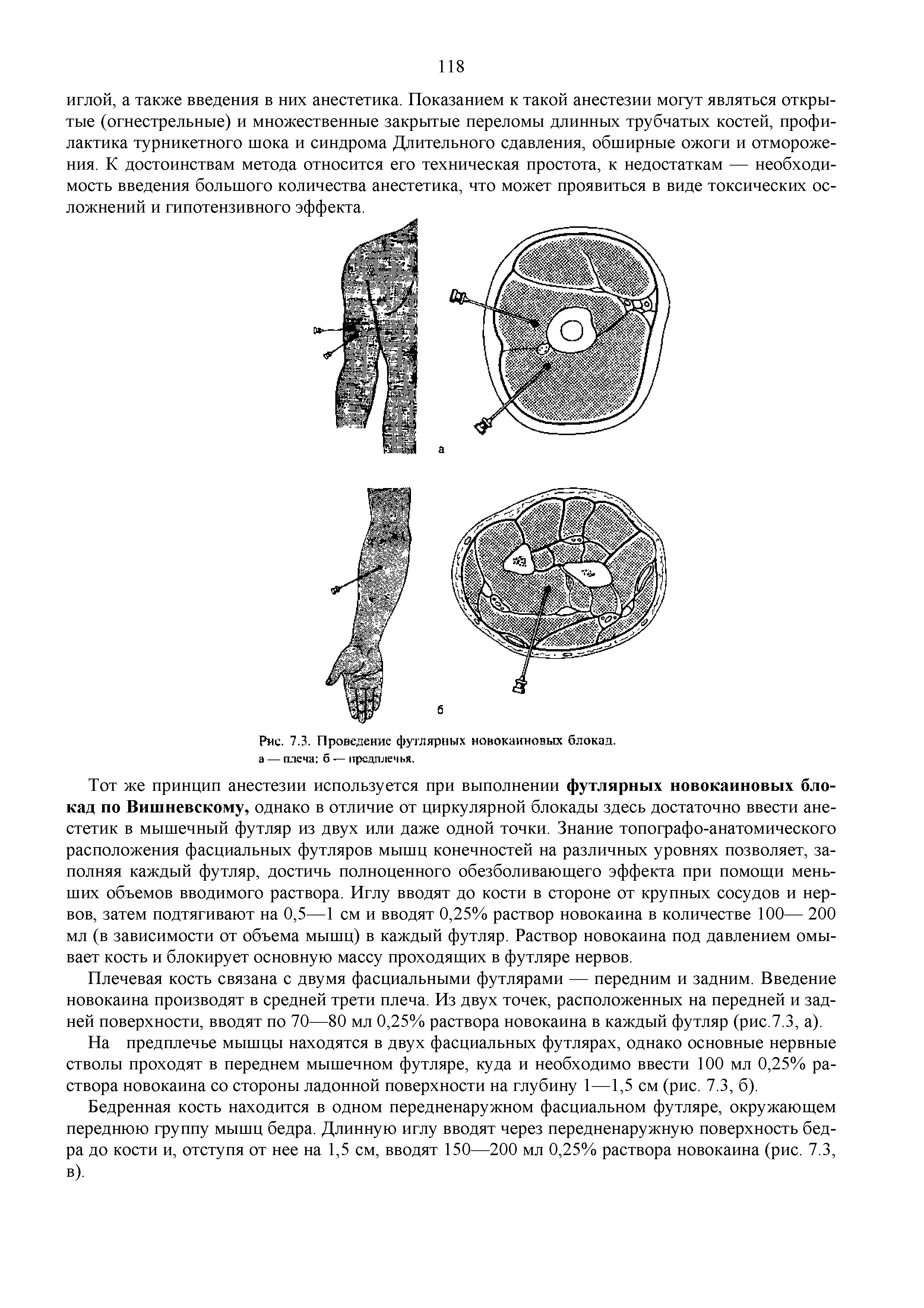 Рис. 7.3. Проведение футлярных новокаиновых блокад, и — плеча б — предплечья.