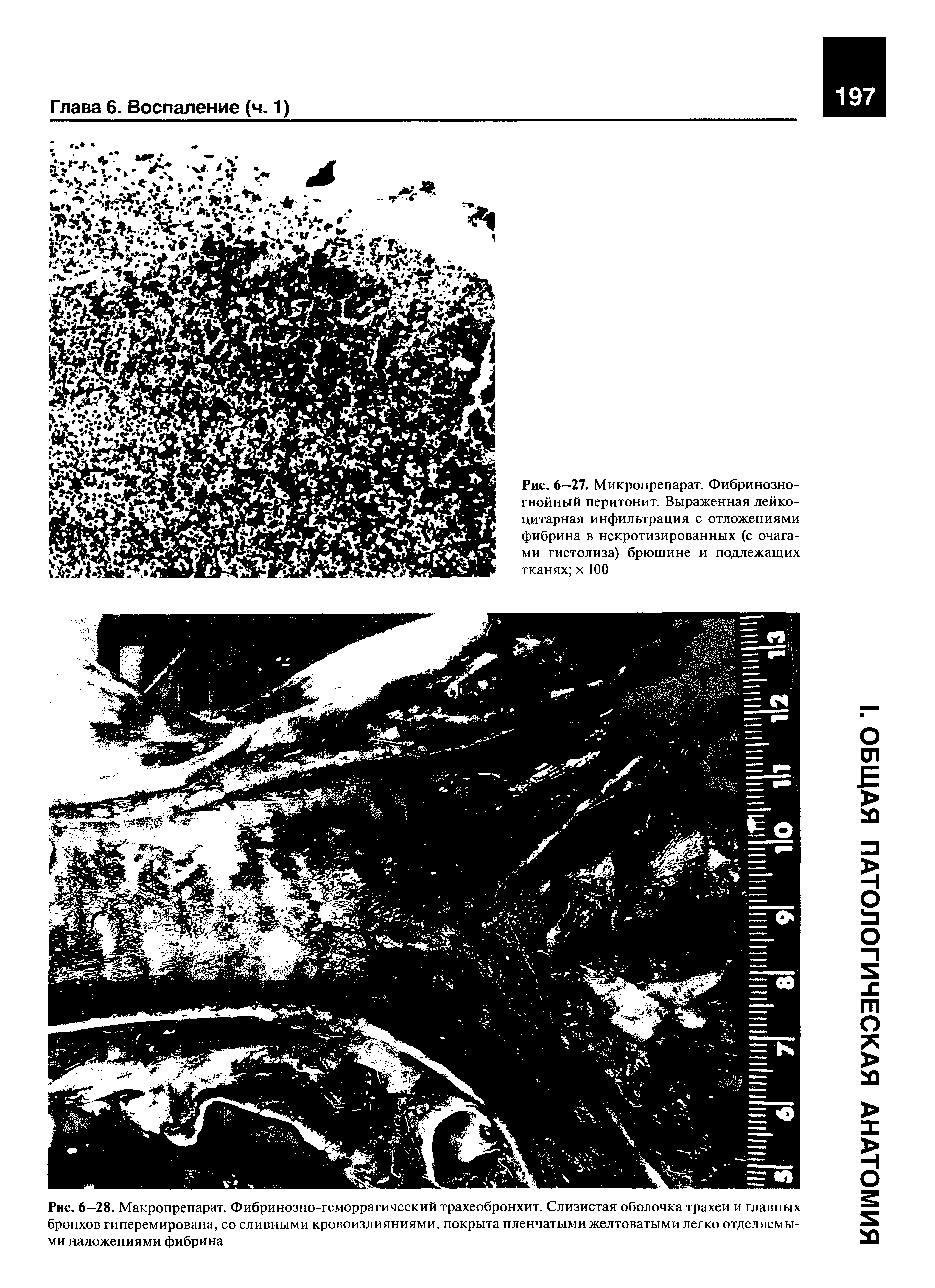 Рис. 6—28. Макропрепарат. Фибринозно-геморрагический трахеобронхит. Слизистая оболочка трахеи и главных бронхов гиперемирована, со сливными кровоизлияниями, покрыта пленчатыми желтоватыми легко отделяемыми наложениями фибрина...