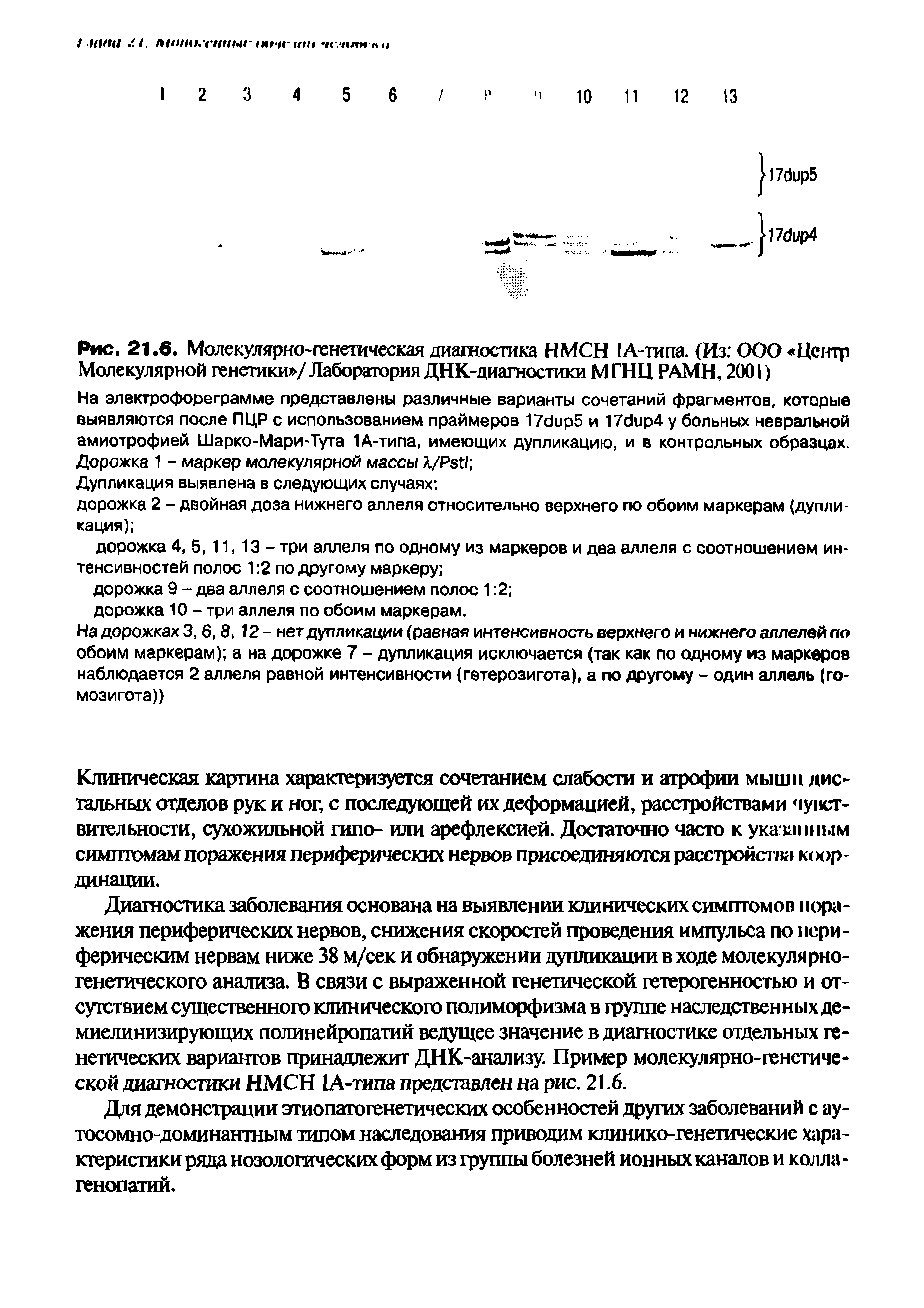 Рис. 21.6. Молекулярно-генетическая диагностика НМСН 1А-типа. (Из ООО Центр Молекулярной генетики / Лаборатория ДНК-диагностики М ГНЦ РАМН, 2001)...