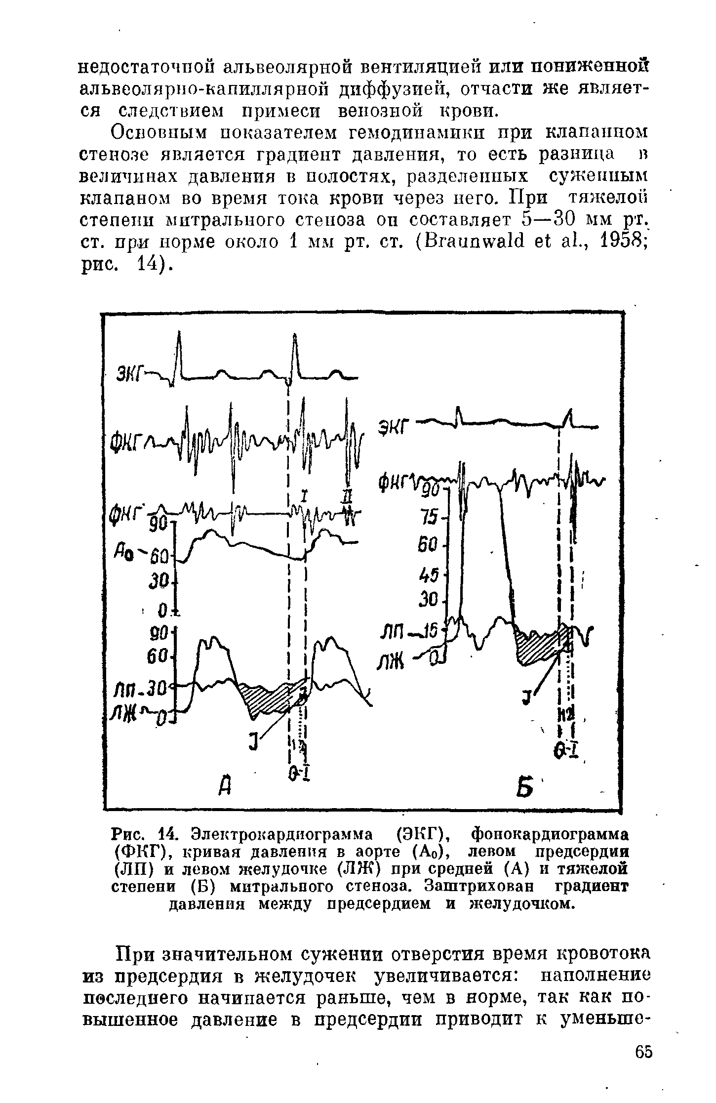 Рис. 14. Электрокардиограмма (ЭКГ), фонокардиограмма (ФКГ), кривая давления в аорте (Ао), левом предсердии (ЛП) и левом желудочке (ЛЖ) при средней (А) и тяжелой степени (Б) митрального стеноза. Заштрихован градиент давления между предсердием и желудочком.