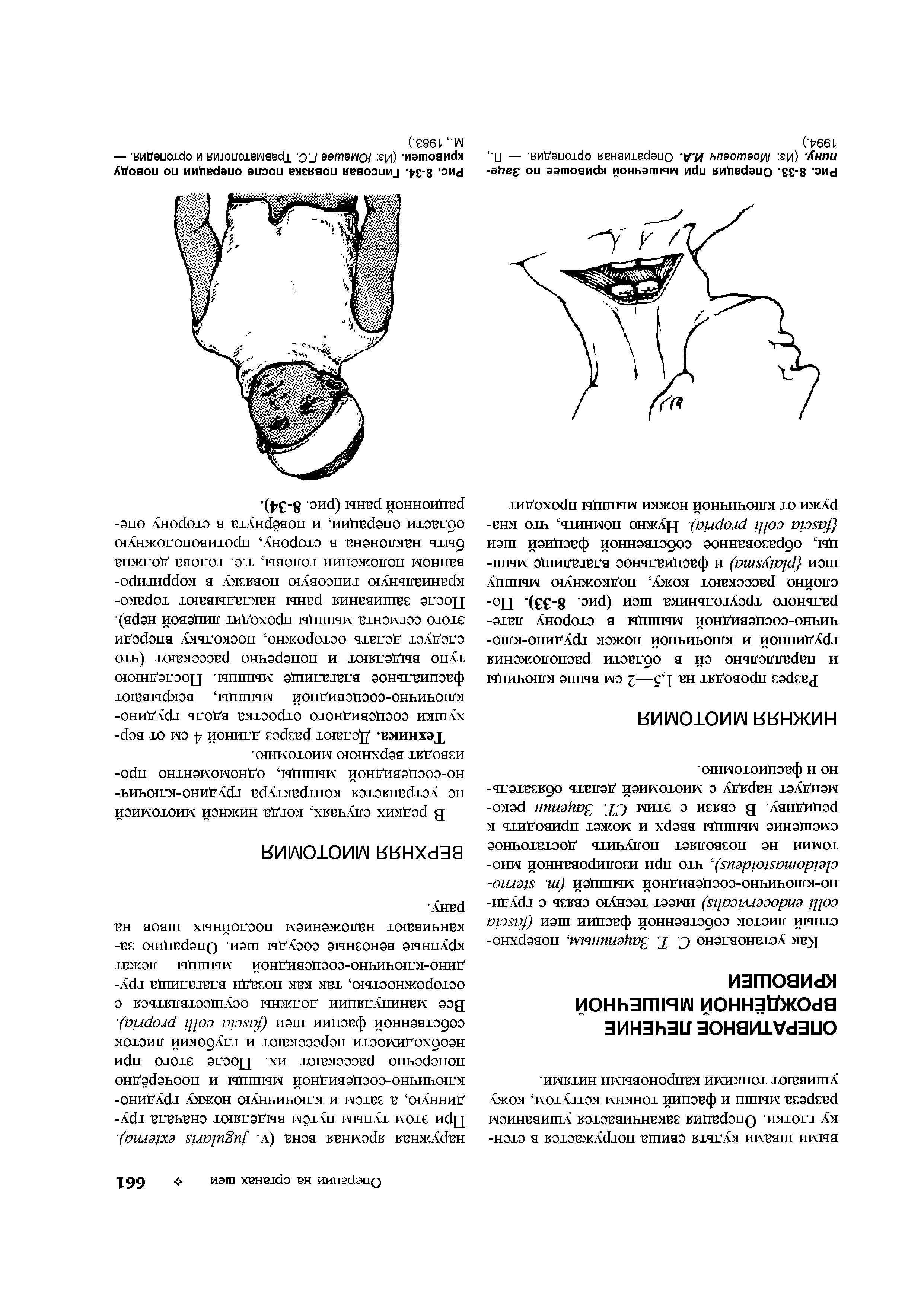 Рис. 8-33. Операция при мышечной кривошее по Зацепину. (Из Мовшович И.А. Оперативная ортопедия. — П., 1994.)...