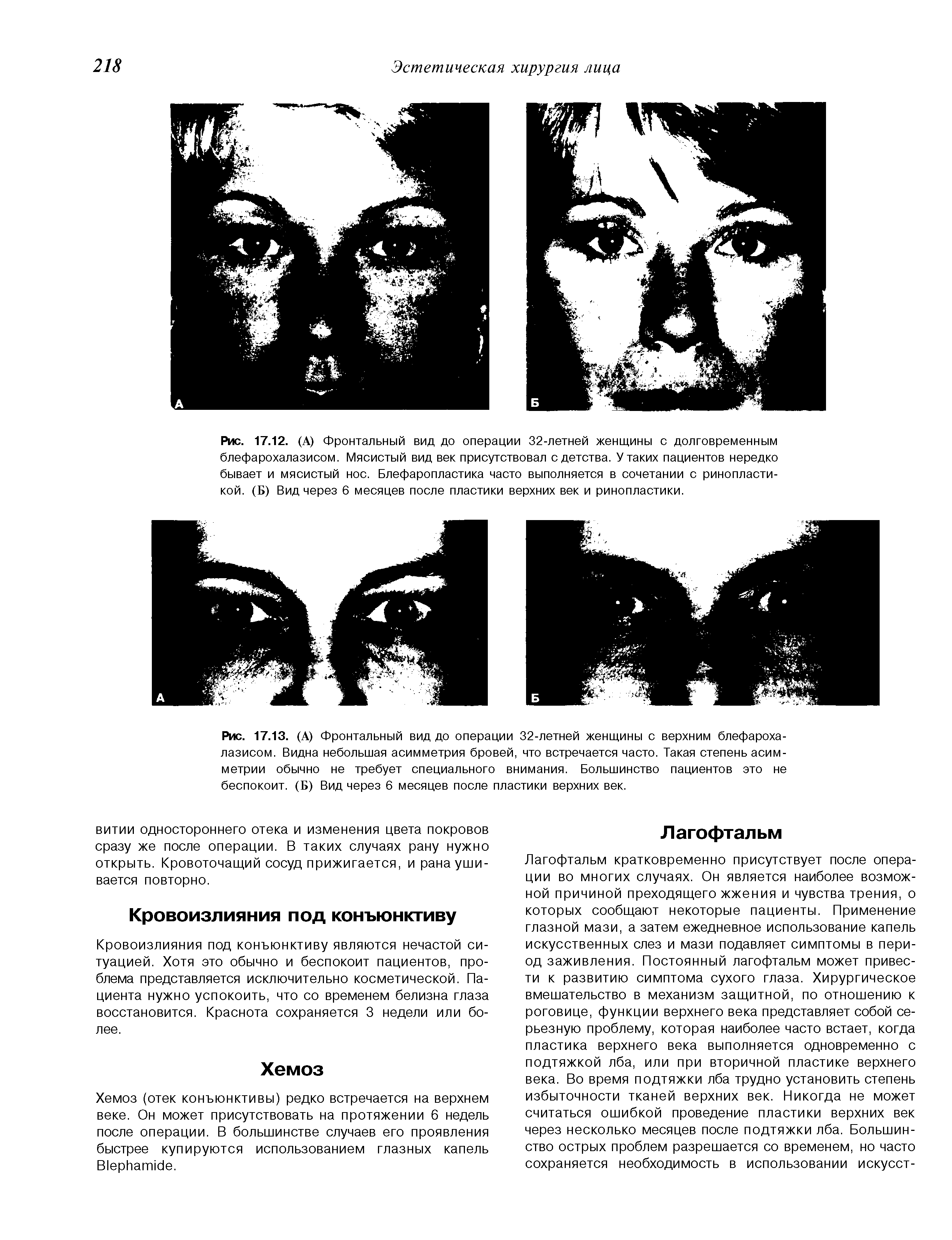 Рис. 17.13. (А) Фронтальный вид до операции 32-летней женщины с верхним блефарохалазисом. Видна небольшая асимметрия бровей, что встречается часто. Такая степень асимметрии обычно не требует специального внимания. Большинство пациентов это не беспокоит. (Б) Вид через 6 месяцев после пластики верхних век.