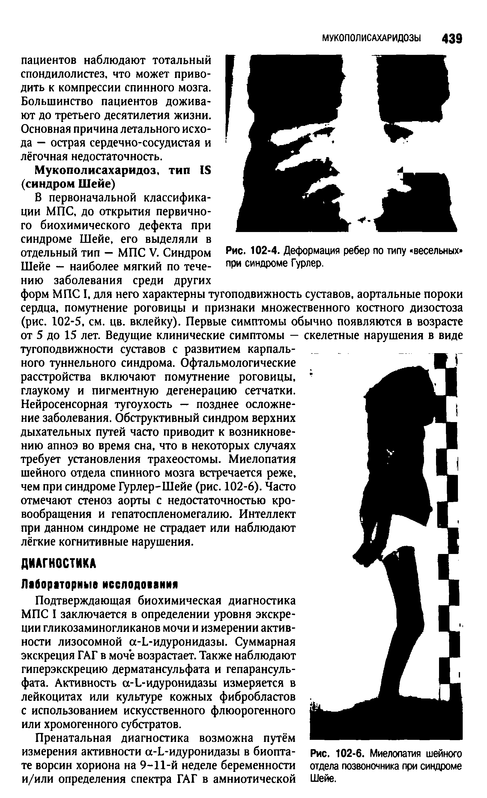 Рис. 102-6. Миелопатия шейного отдела позвоночника при синдроме Шейе.