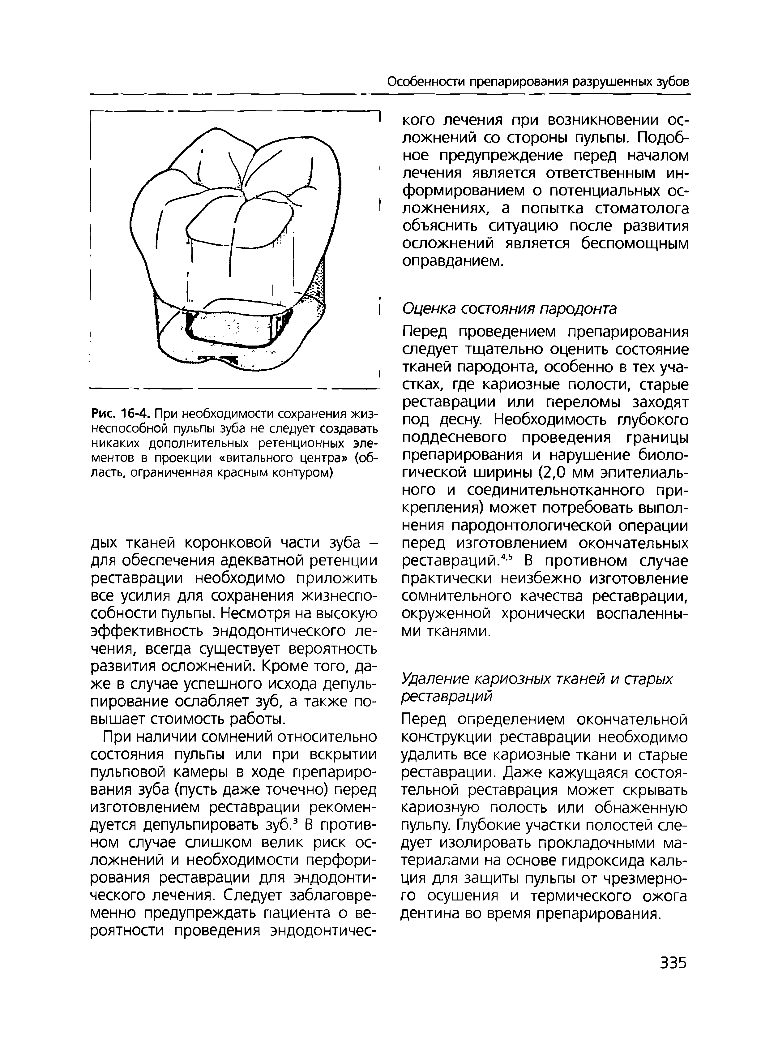 Рис. 16-4. При необходимости сохранения жизнеспособной пульпы зуба не следует создавать никаких дополнительных ретенционных элементов в проекции витального центра (область, ограниченная красным контуром)...