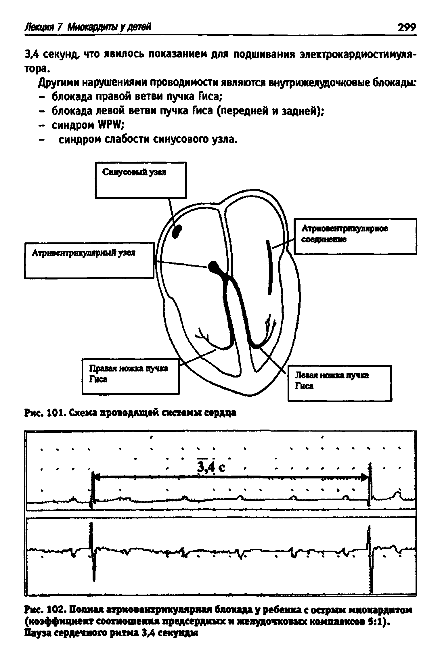 Рис. 102. Полная атриовентрикулярная блокада у ребенка с острый миокардитом (коэффициент соотношении предсердных и желудочковых комплексов 5 1). Пауза сердечного ритма ЗЛ секунды...