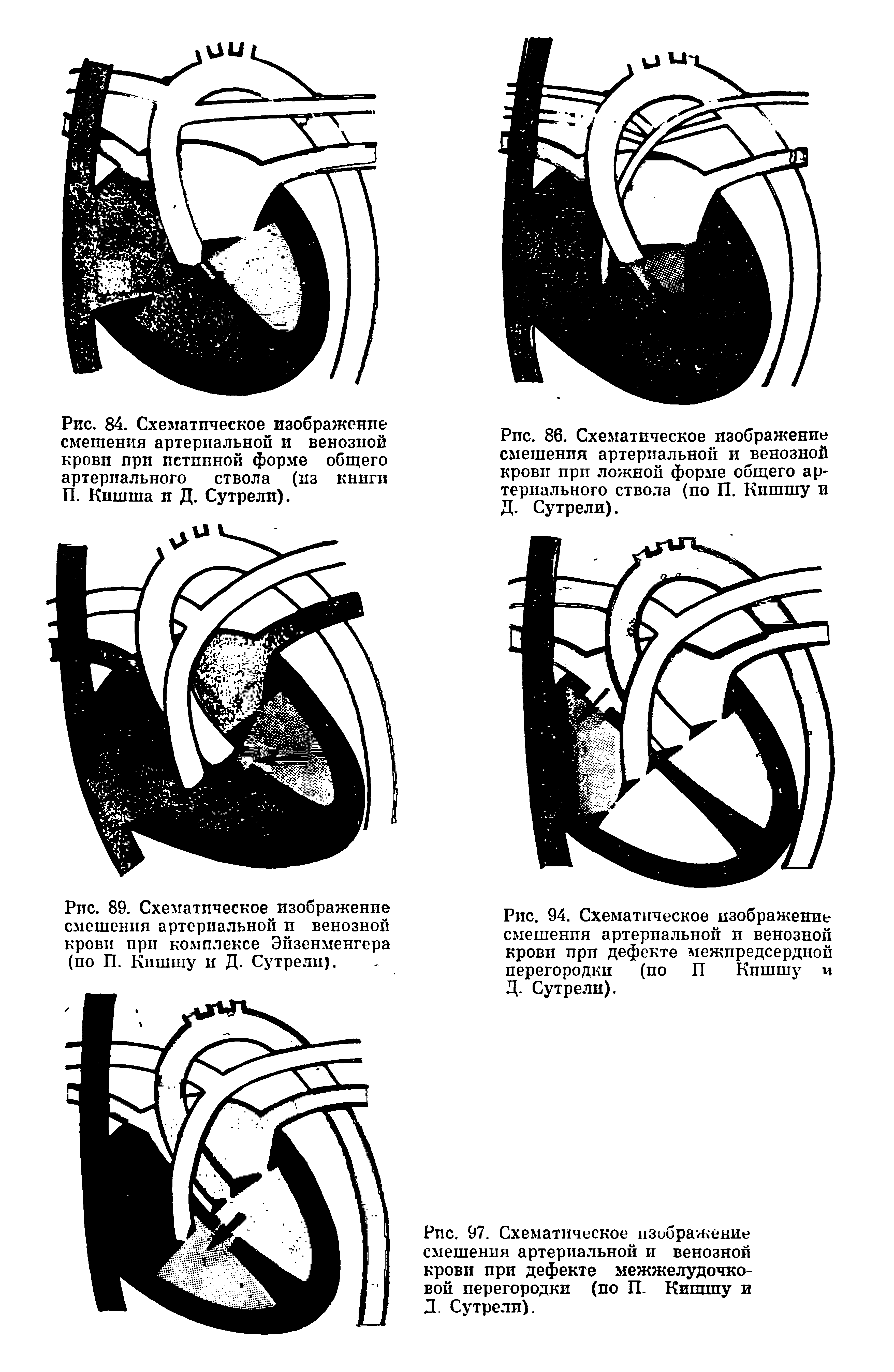 Рис. 86. Схематическое изображение смешения артериальной и венозной крови при ложной форме общего артериального ствола (по П. Кпшшу и Д. Сутрели).