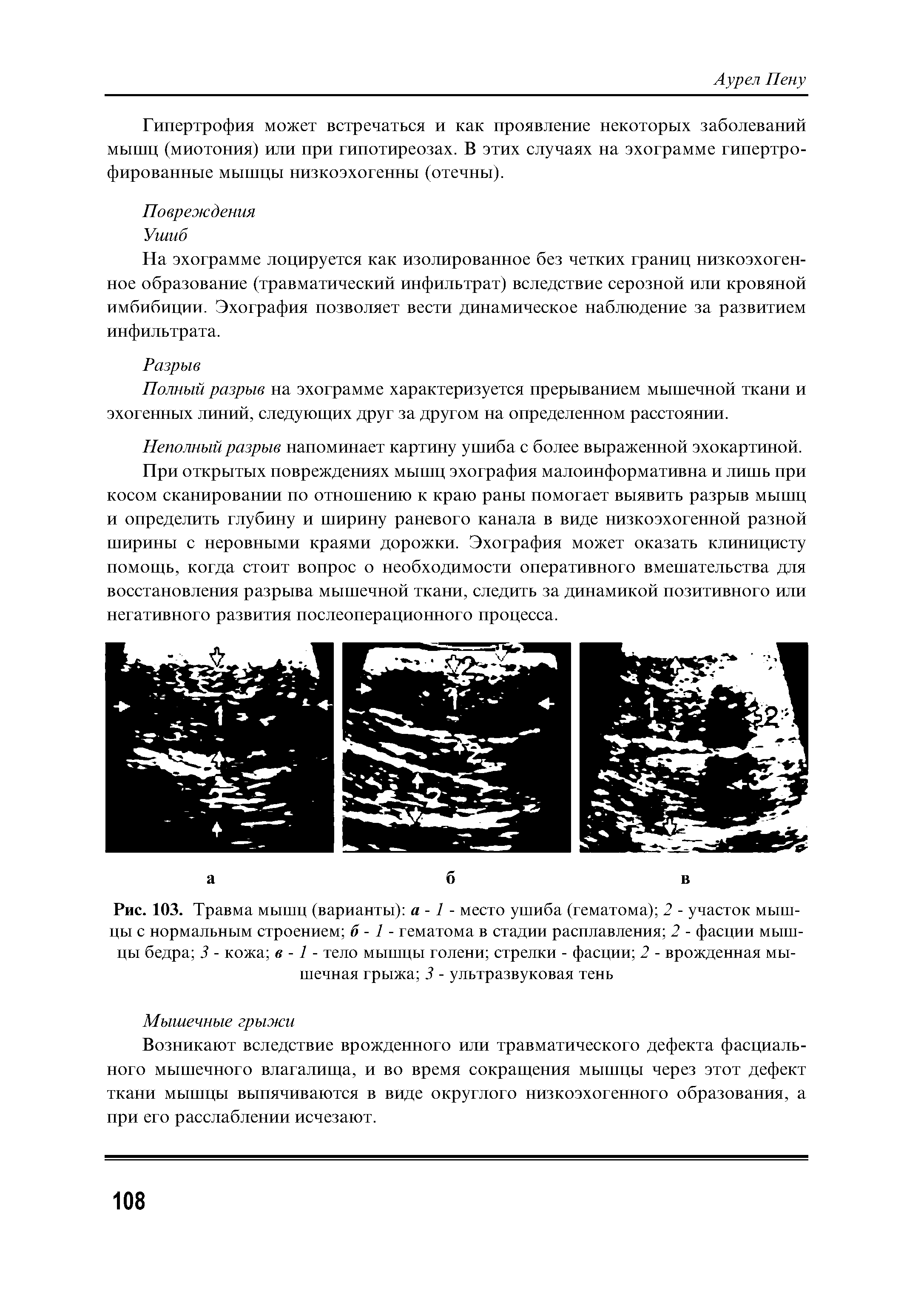 Рис. 103. Травма мышц (варианты) а -1 - место ушиба (гематома) 2 - участок мышцы с нормальным строением б - 1 - гематома в стадии расплавления 2 - фасции мышцы бедра 3 - кожа в -1 - тело мышцы голени стрелки - фасции 2 - врожденная мышечная грыжа 3 - ультразвуковая тень...