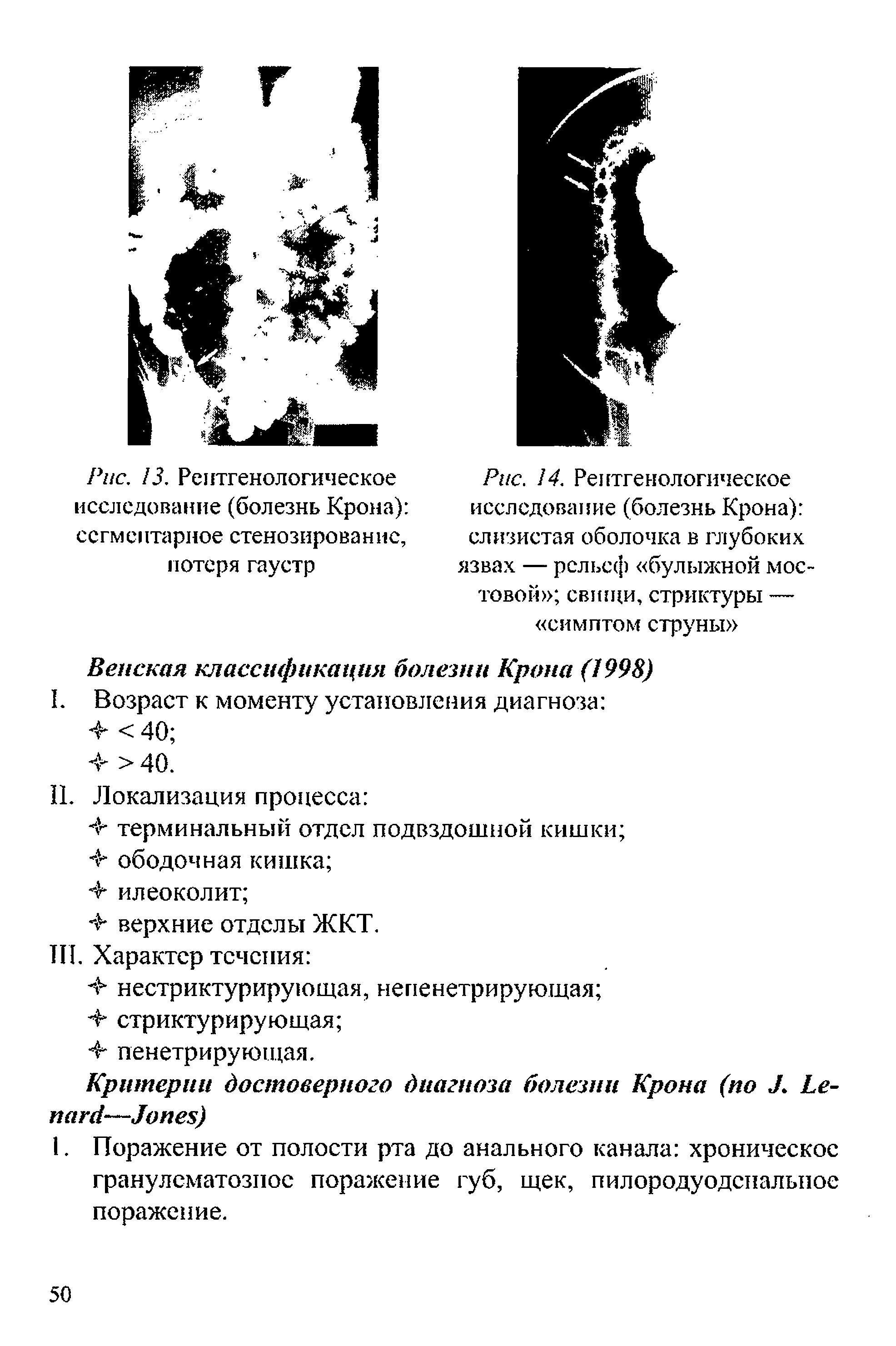 Рис. 14. Рентгенологическое исследование (болезнь Крона) слизистая оболочка в глубоких язвах — рельеф булыжной мостовой свищи, стриктуры — симптом струны ...