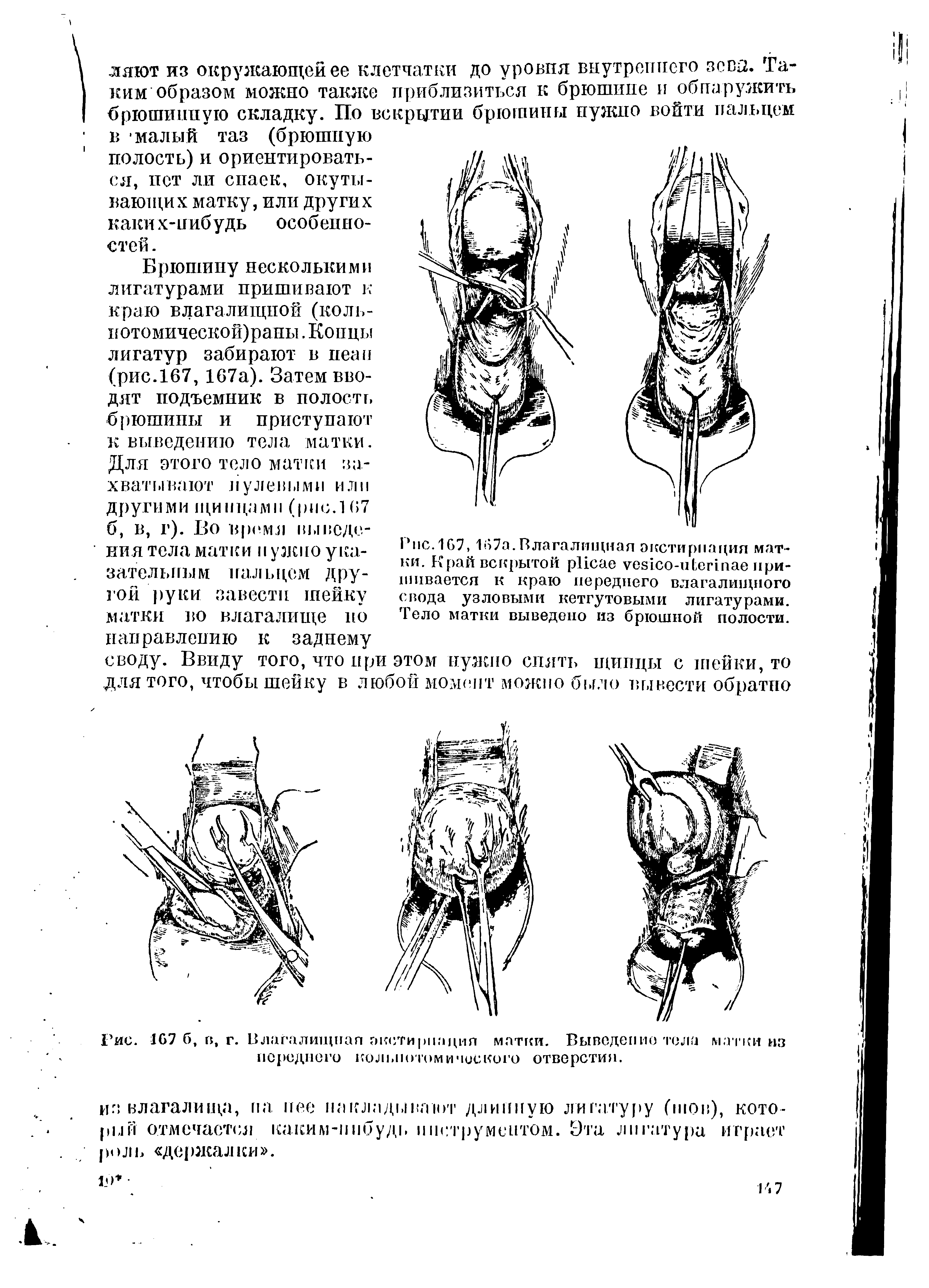 Рис.167, 167а.Влагалищная экстирпация матки. Край вскрытой - пришивается к краю переднего влагалищного свода узловыми кетгутовыми лигатурами. Тело матки выведено из брюшной полости.