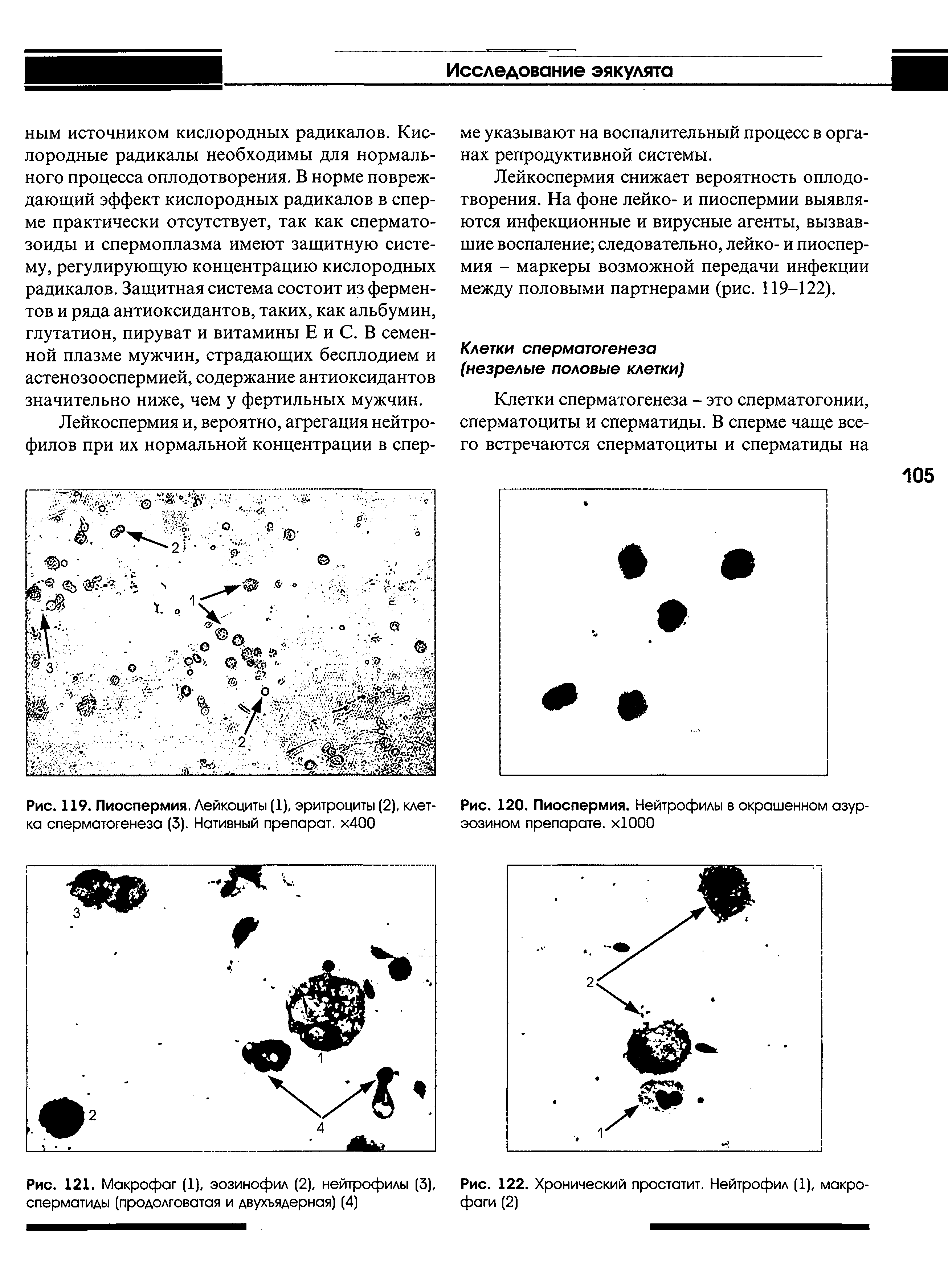 Рис. 119. Пиоспермия. Лейкоциты (1), эритроциты (2), клетка сперматогенеза (3). Нативный препарат. х400...