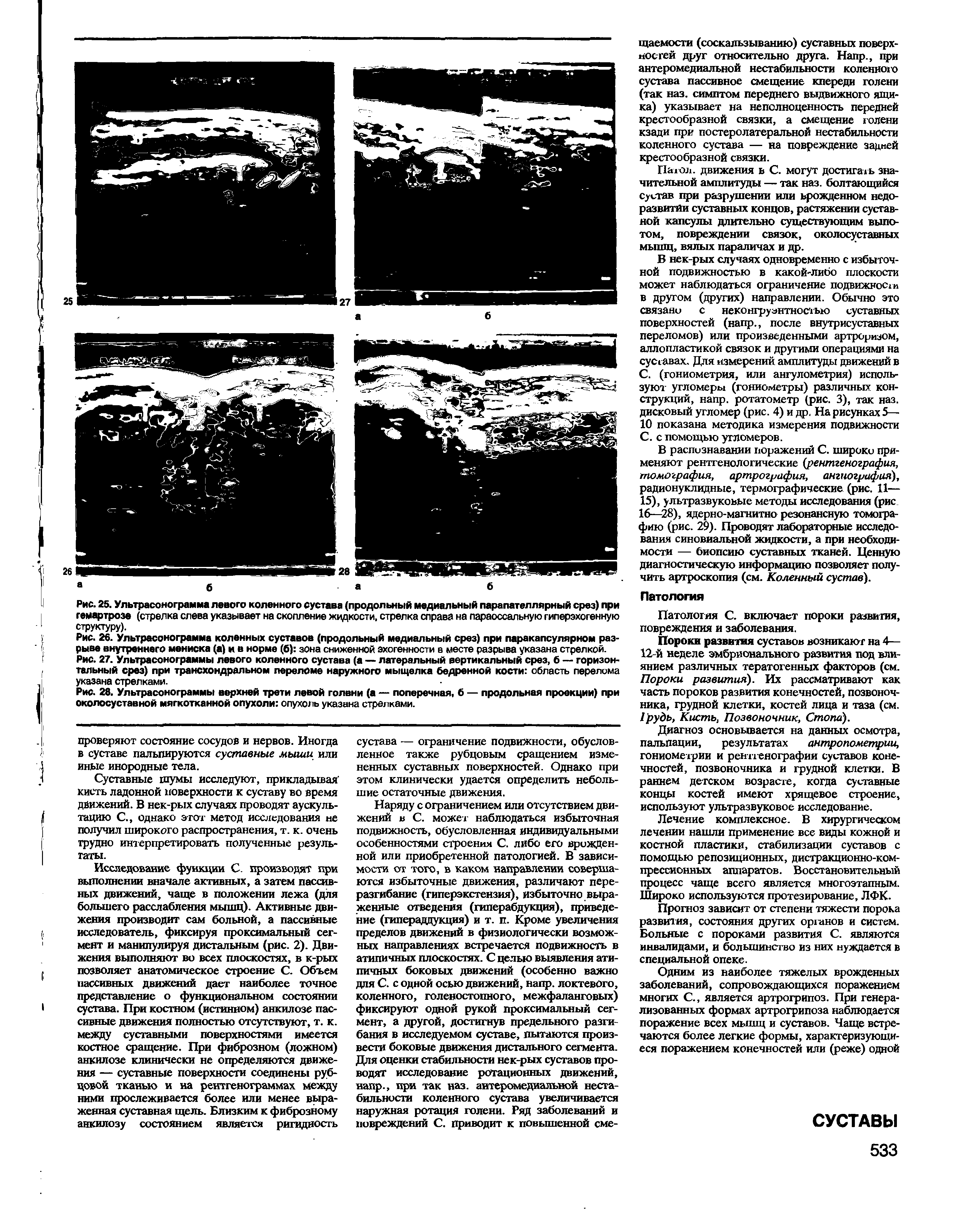 Рис. 27. Ультрасонограммы левого коленного сустава (а — латеральный вертикальный срез, б — горизонтальный срез) при трансхондральном переломе наружного мыщелка бедренной кости область перелома указана стрелками.