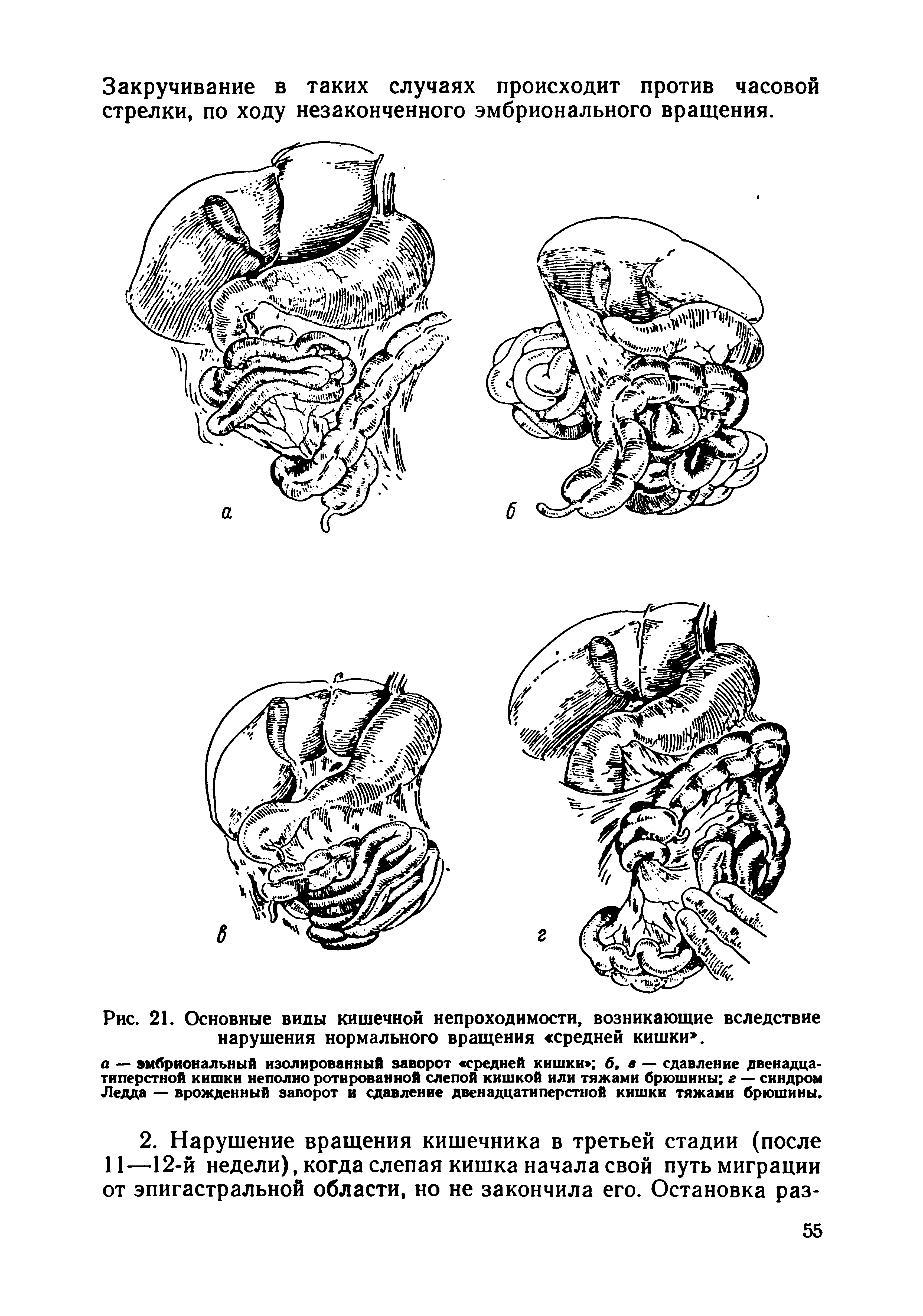 Рис. 21. Основные виды кишечной непроходимости, возникающие вследствие нарушения нормального вращения средней кишки .