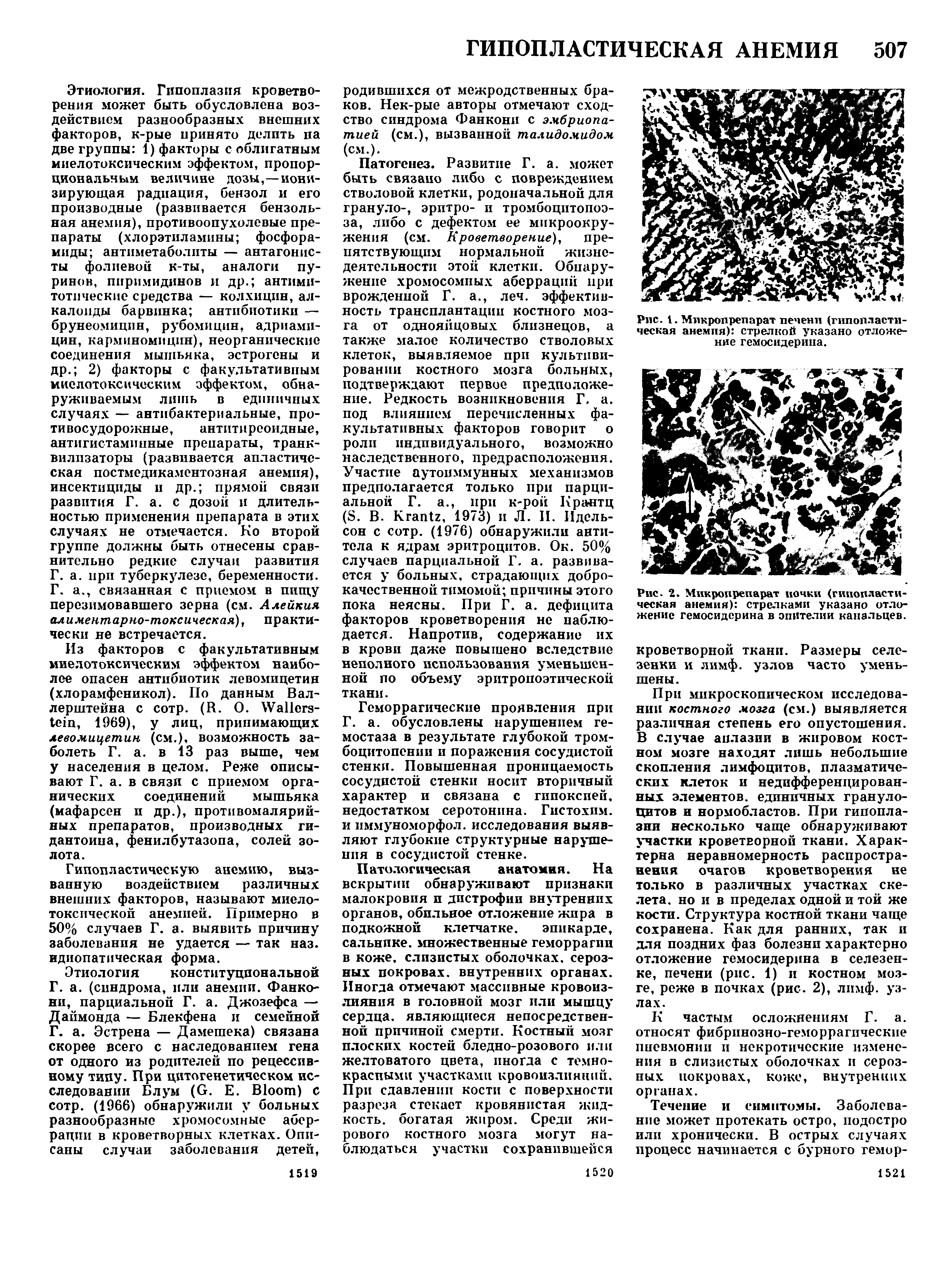 Рис. 2. Микропрепарат почки (гипопластическая анемия) стрелками указано отложение гемосидерина в эпителии канальцев.