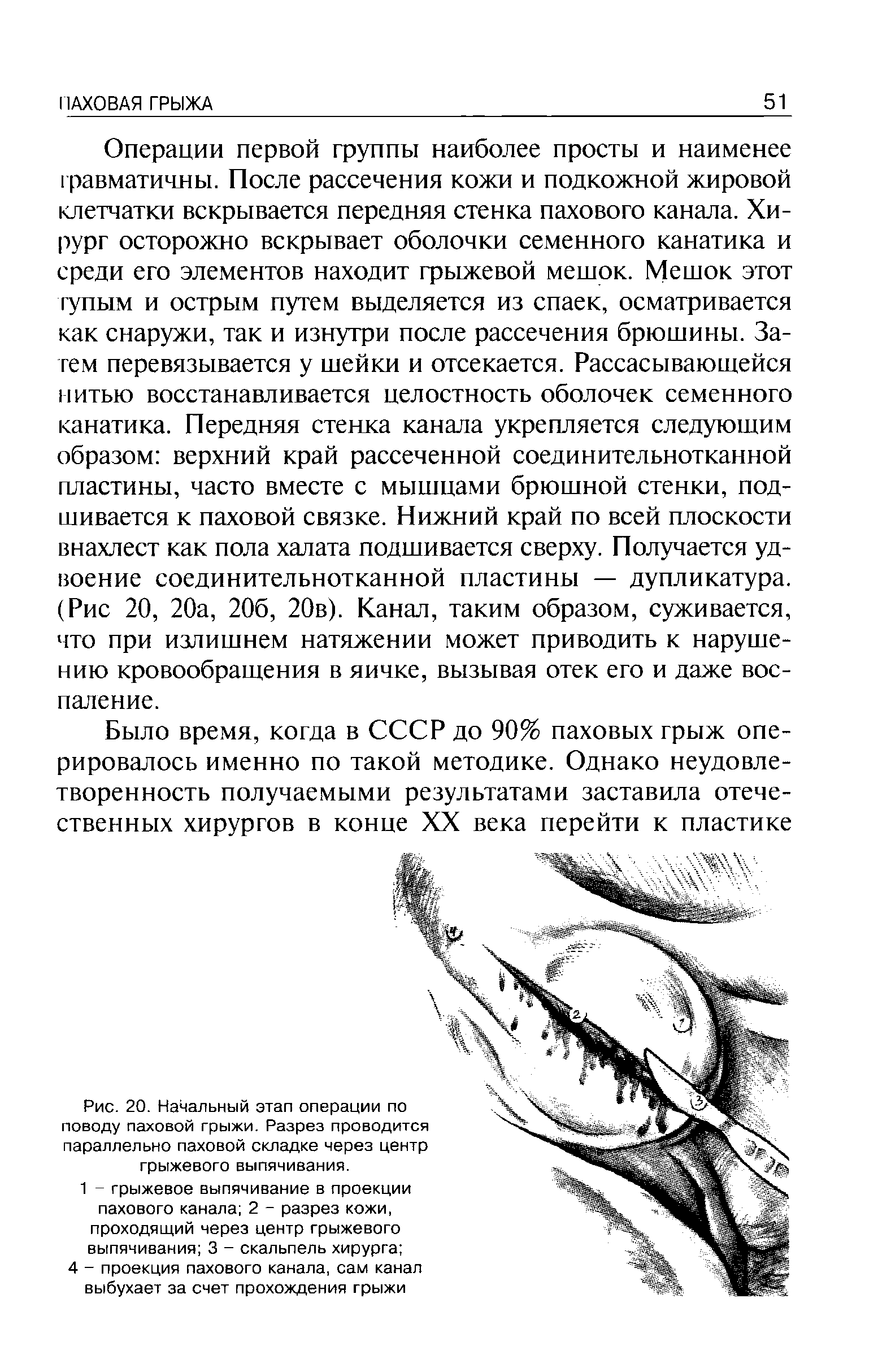 Рис. 20. Начальный этап операции по поводу паховой грыжи. Разрез проводится параллельно паховой складке через центр грыжевого выпячивания.