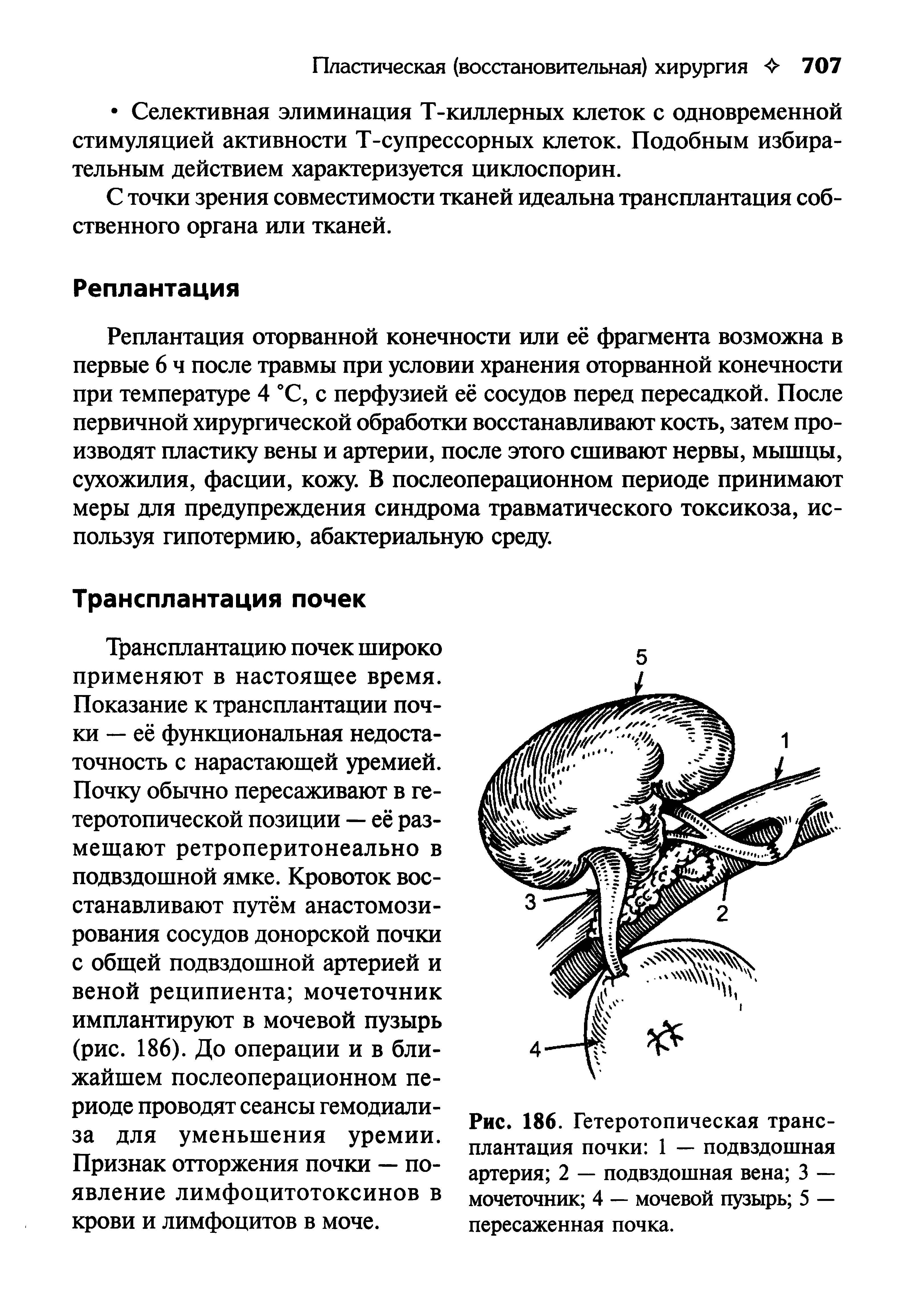 Рис. 186. Гетеротопическая трансплантация почки 1 — подвздошная артерия 2 — подвздошная вена 3 — мочеточник 4 — мочевой пузырь 5 — пересаженная почка.