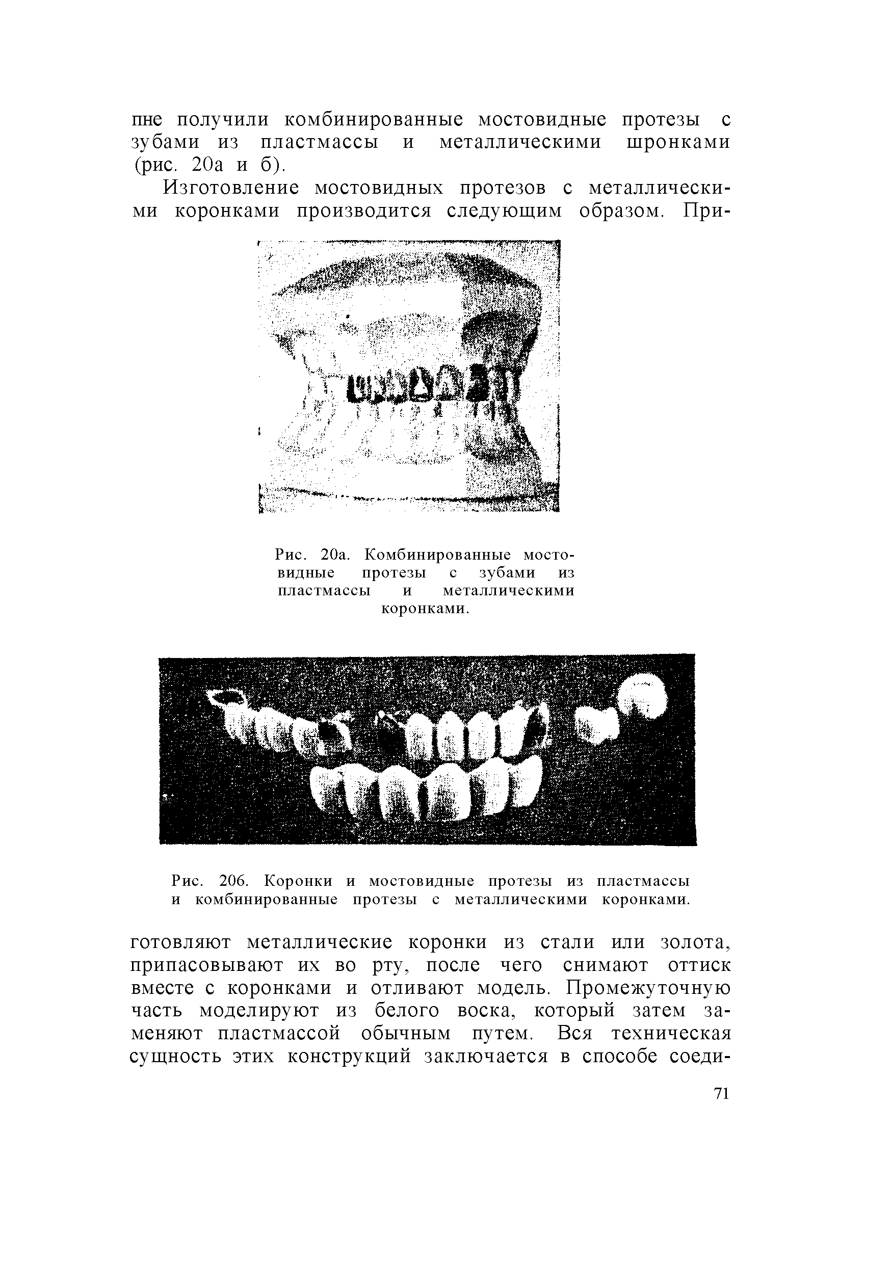 Рис. 206. Коронки и мостовидные протезы из пластмассы и комбинированные протезы с металлическими коронками.