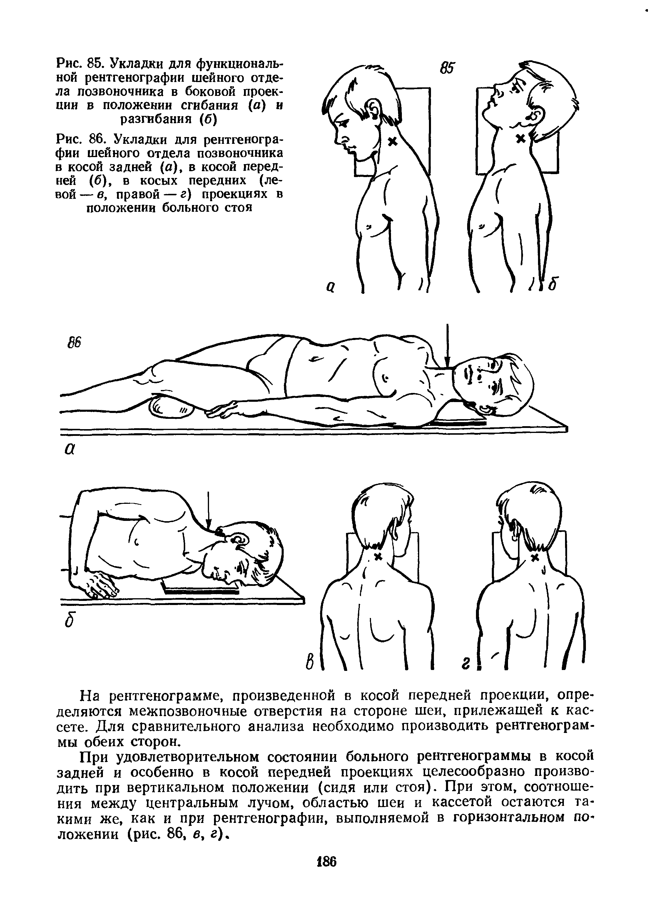 Рис. 86. Укладки для рентгенографии шейного отдела позвоночника в косой задней (о), в косой передней (б), в косых передних (левой — в, правой — г) проекциях в положении больного стоя...