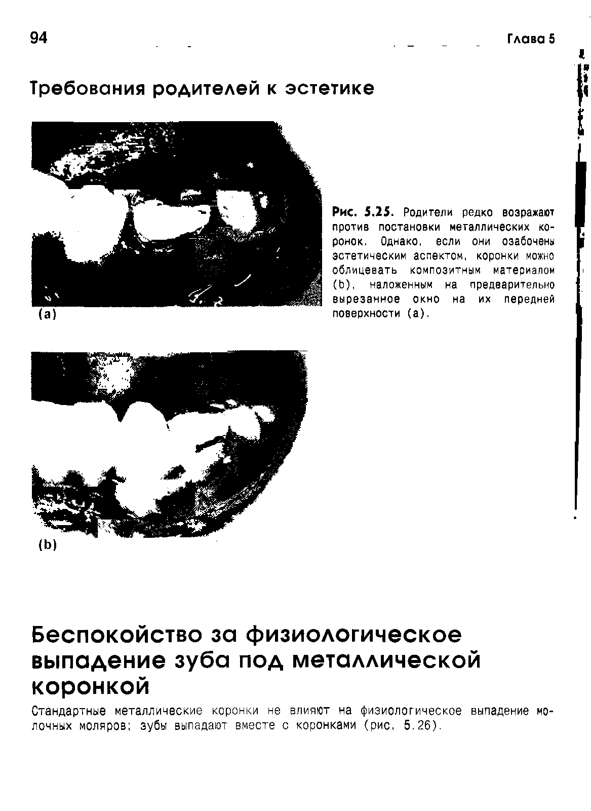 Рис. 5.25. Родители редко возражают против постановки металлических коронок. Однако, если они озабочены эстетическим аспектом, коронки можно облицевать композитным материалом (Ь), наложенным на предварительно вырезанное окно на их передней поверхности (а).