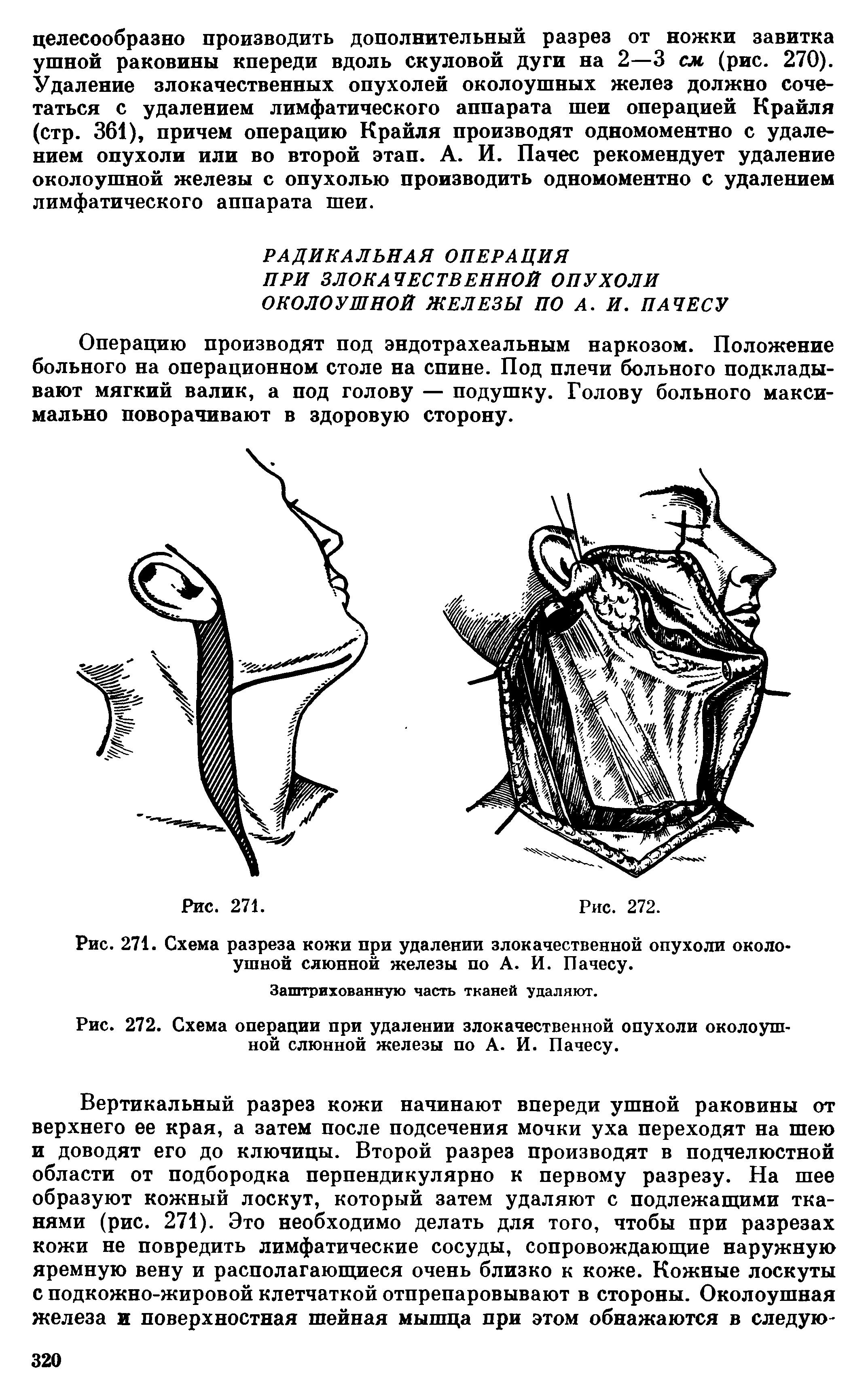 Рис. 272. Схема операции при удалении злокачественной опухоли околоушной слюнной железы по А. И. Пачесу.