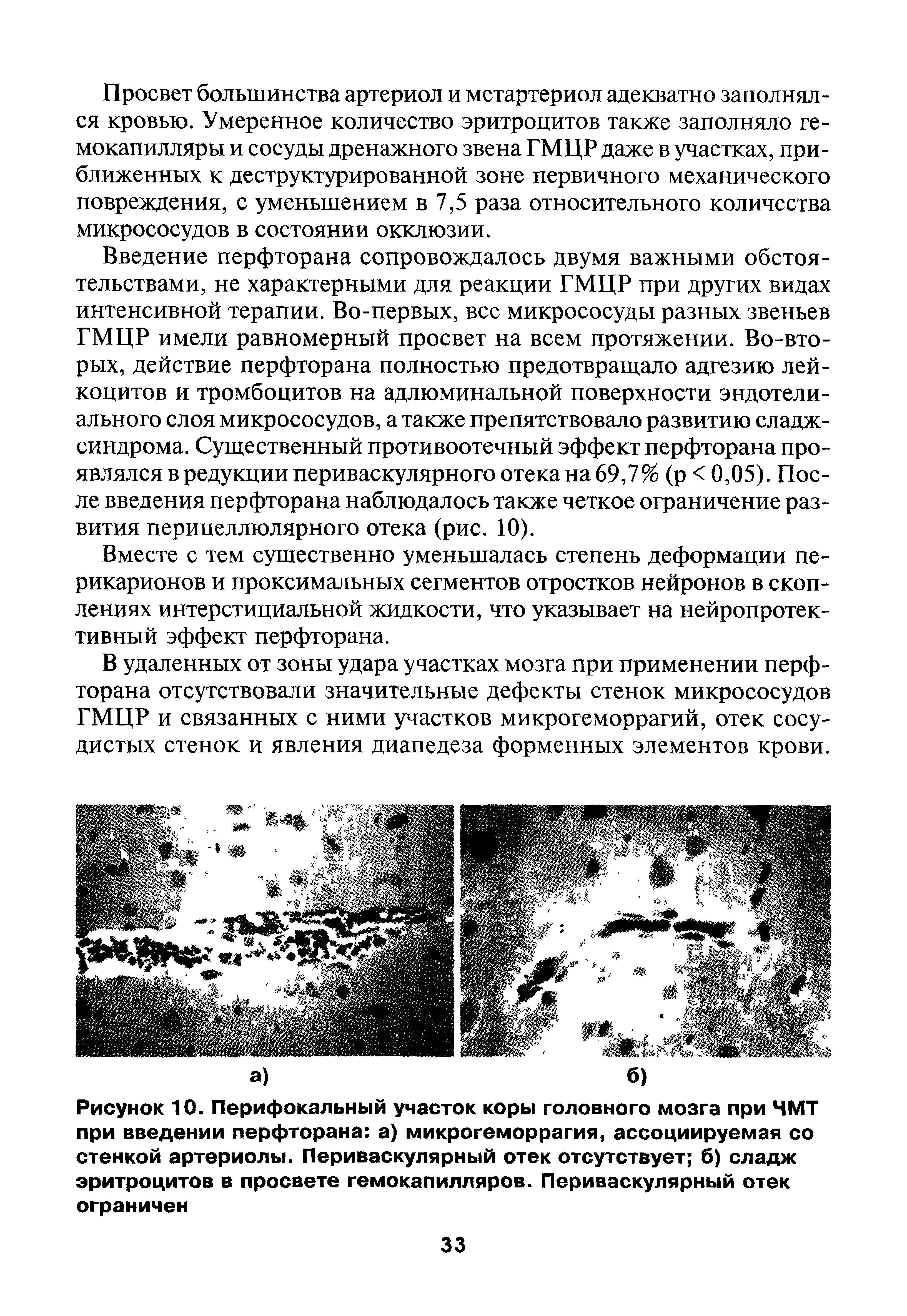 Рисунок 10. Перифокальный участок коры головного мозга при ЧМТ при введении перфторана а) микрогеморрагия, ассоциируемая со стенкой артериолы. Периваскулярный отек отсутствует б) сладж эритроцитов в просвете гемокапилляров. Периваскулярный отек ограничен...