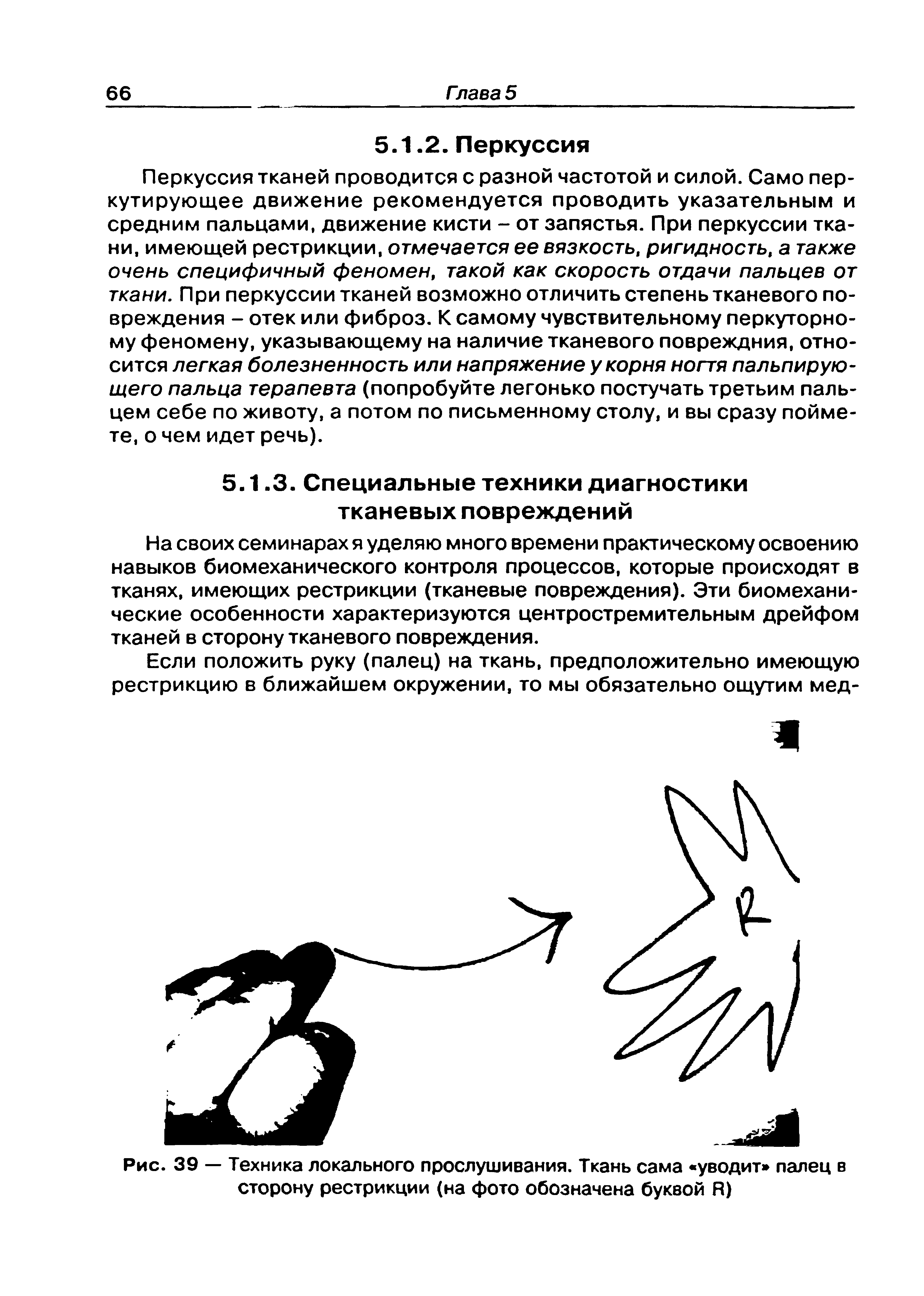 Рис. 39 — Техника локального прослушивания. Ткань сама уводит палец в сторону рестрикции (на фото обозначена буквой Я)...