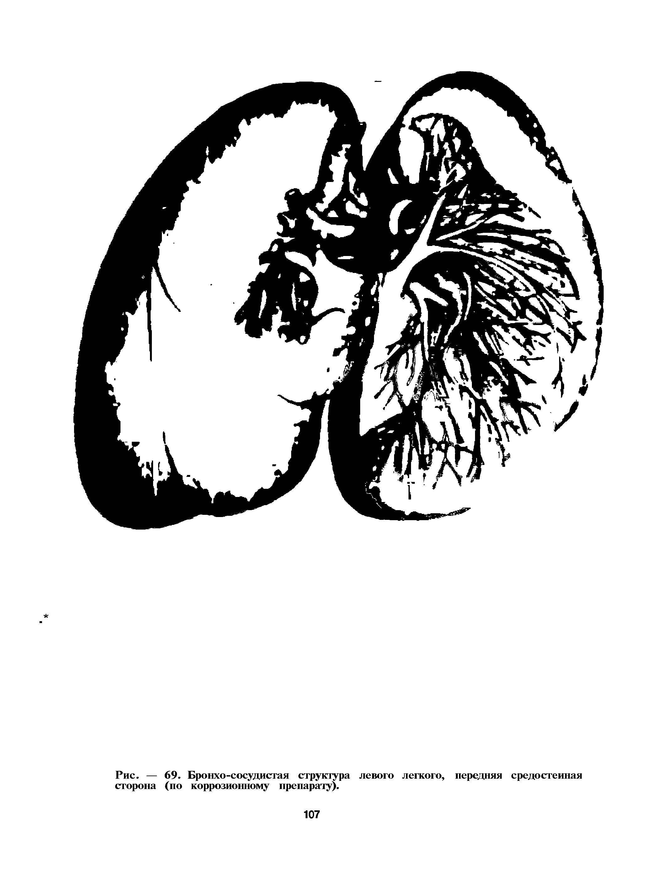 Рис. — 69. Бронхо-сосудистая структура левого легкого, передняя средостенная сторона (по коррозионному препарату).