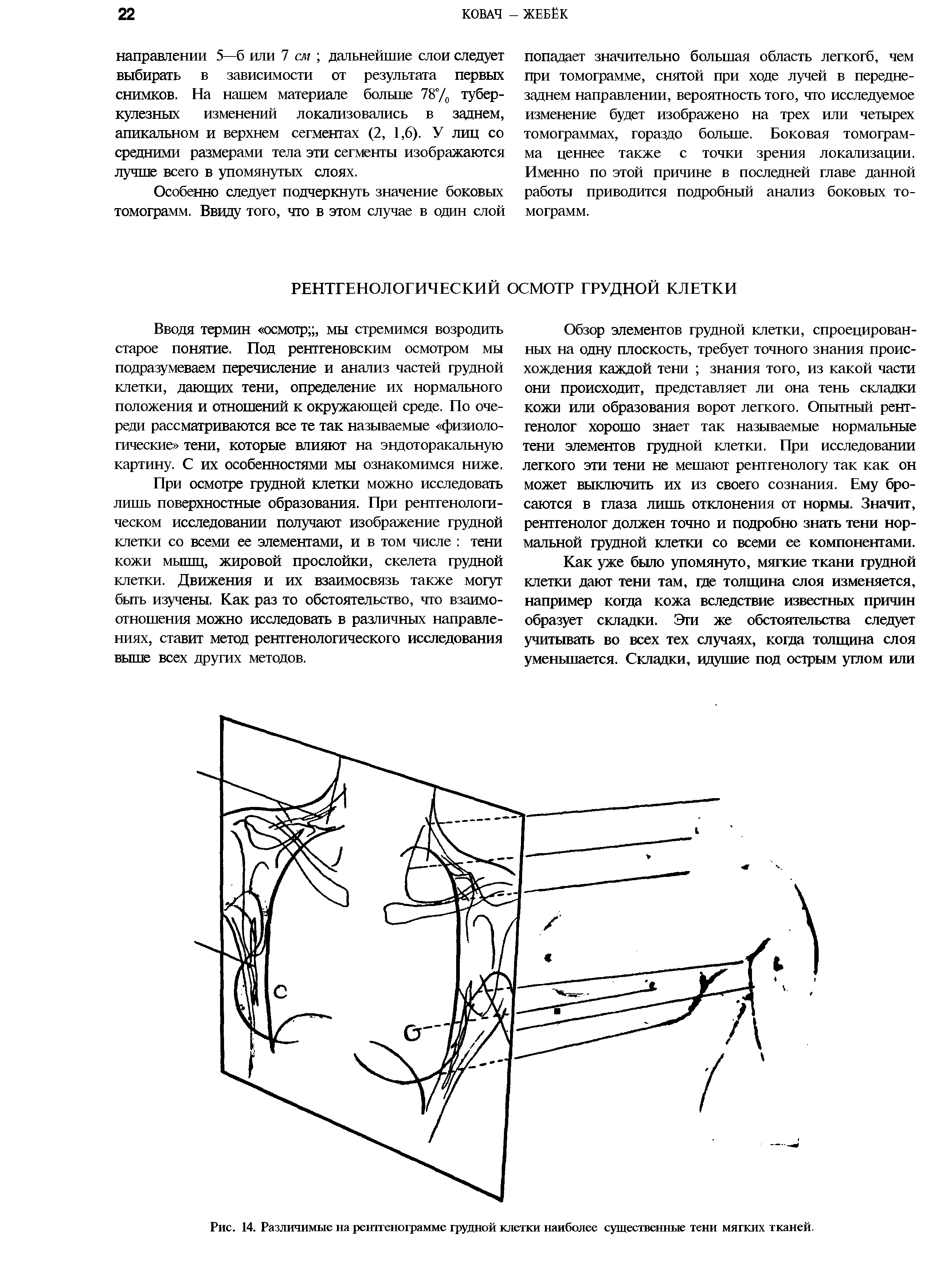 Рис. 14. Различимые на рентгенограмме грудной клетки наиболее существенные тени мягких тканей.