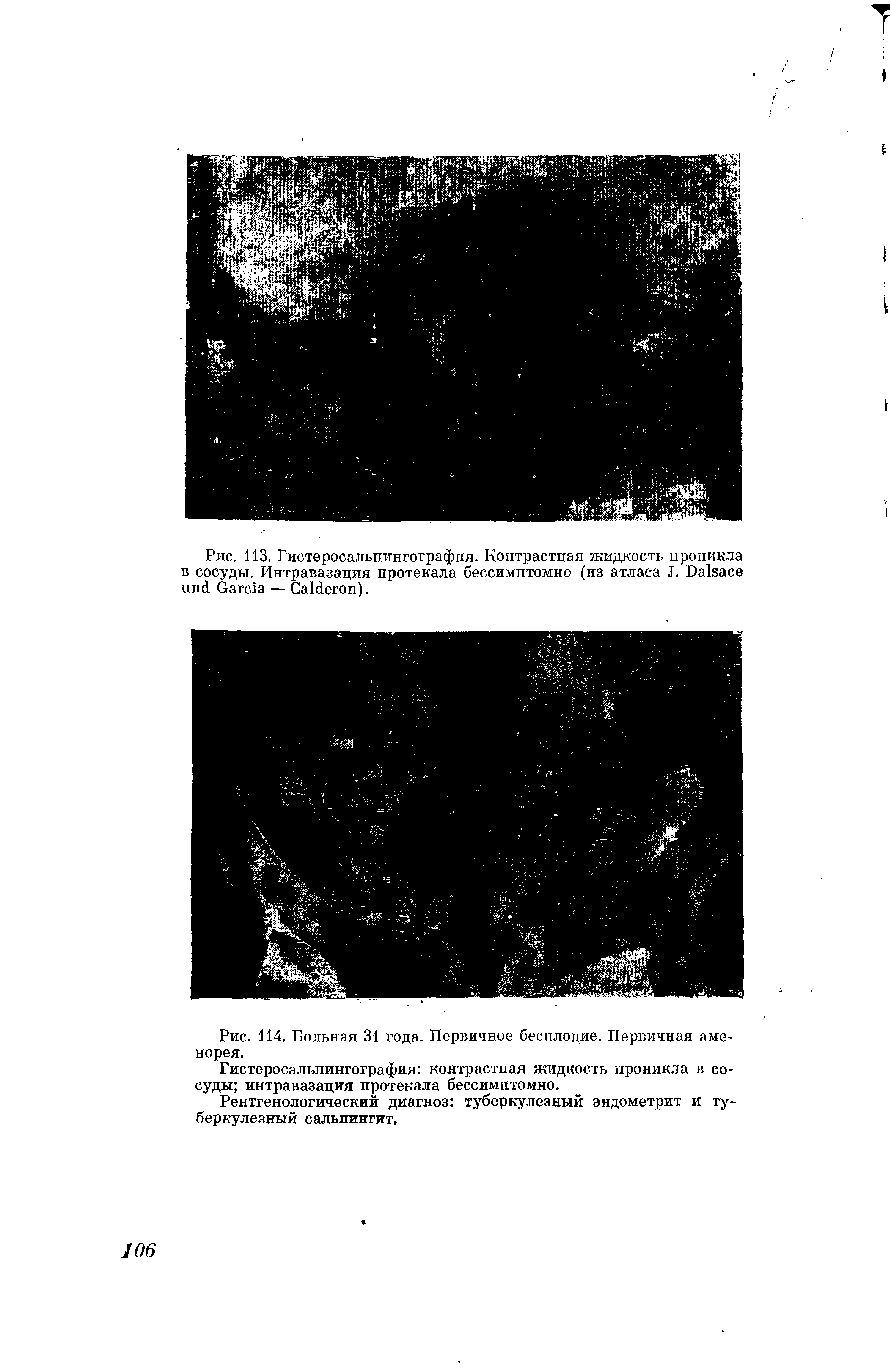 Рис. 114. Больная 31 года. Первичное бесплодие. Первичная аменорея.